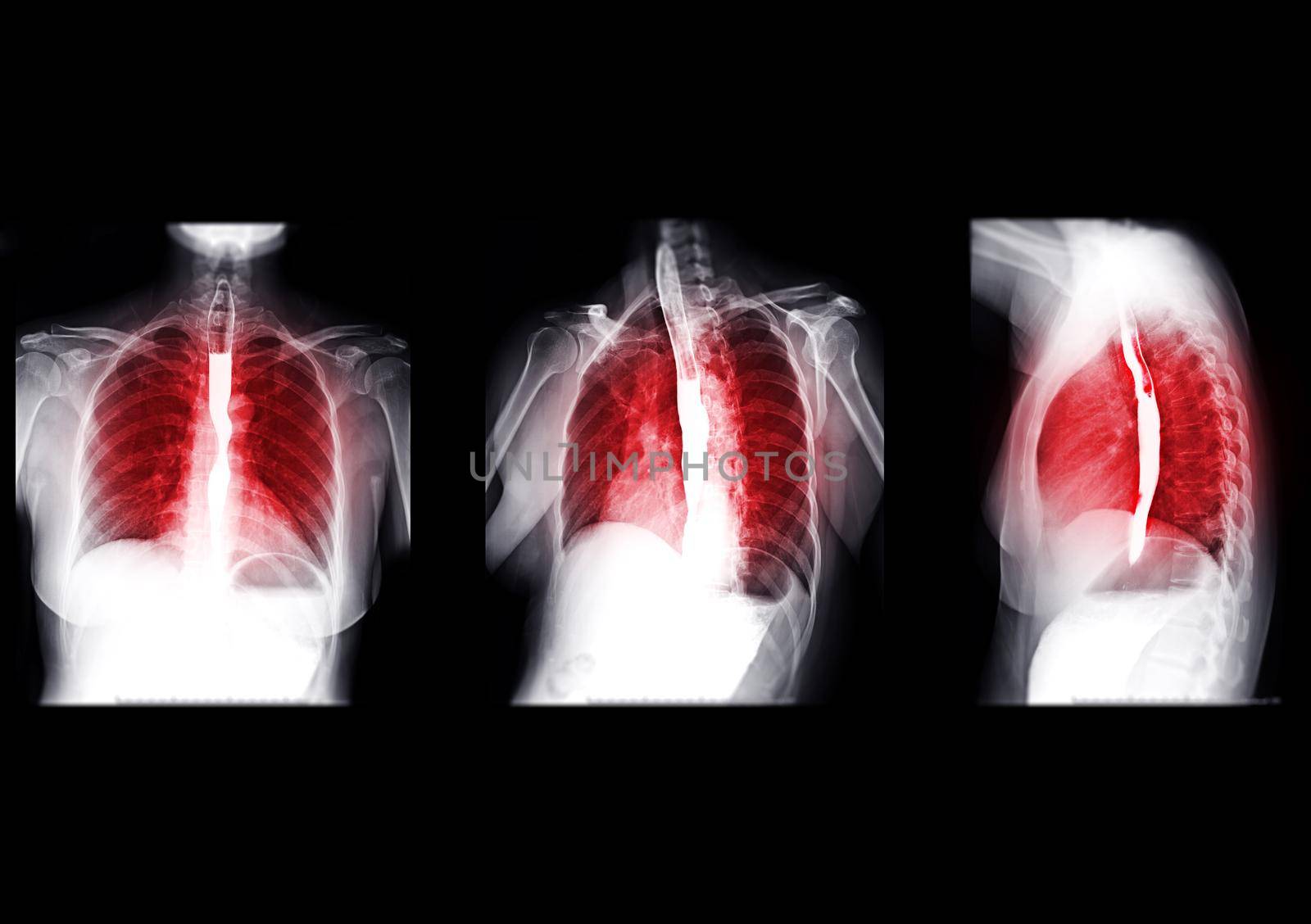 Collection of Esophagram or Barium swallow showing esophagus for diagnosis GERD or Gastroesophageal reflux disease or Esophageal cancer.