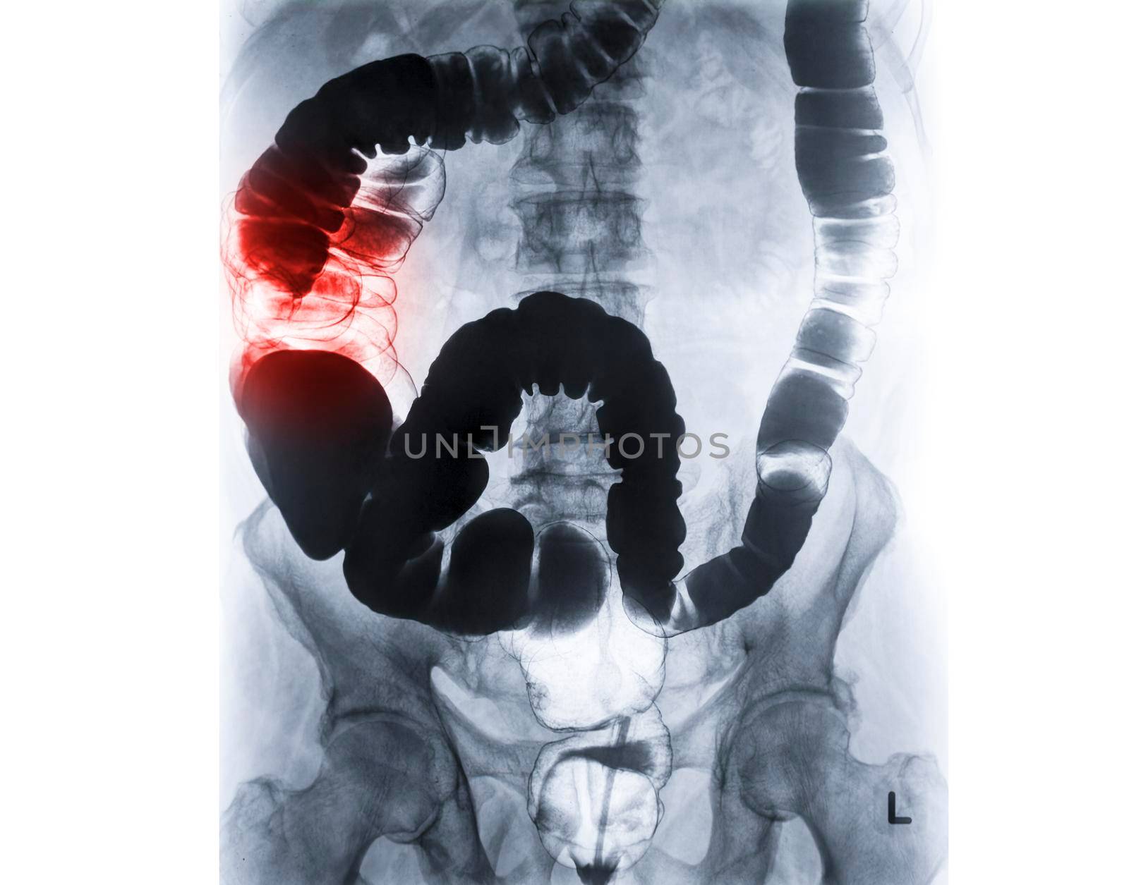 Barium enema or BE is image of large bowel after injection of barium contrast fill into colon under fluoroscopic control by samunella