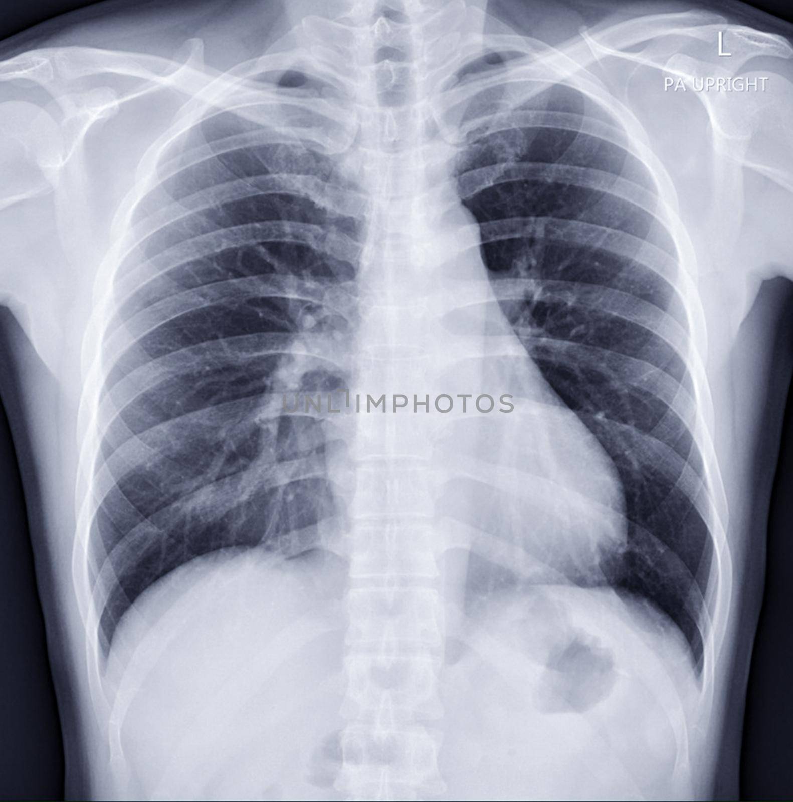 Chest x-ray image for diagnosis TB,tuberculosis and covid-19.