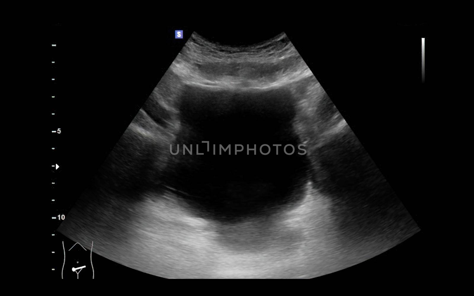 Ultrasound of urinary bladder or KUB for screening renal and bladder disease. by samunella