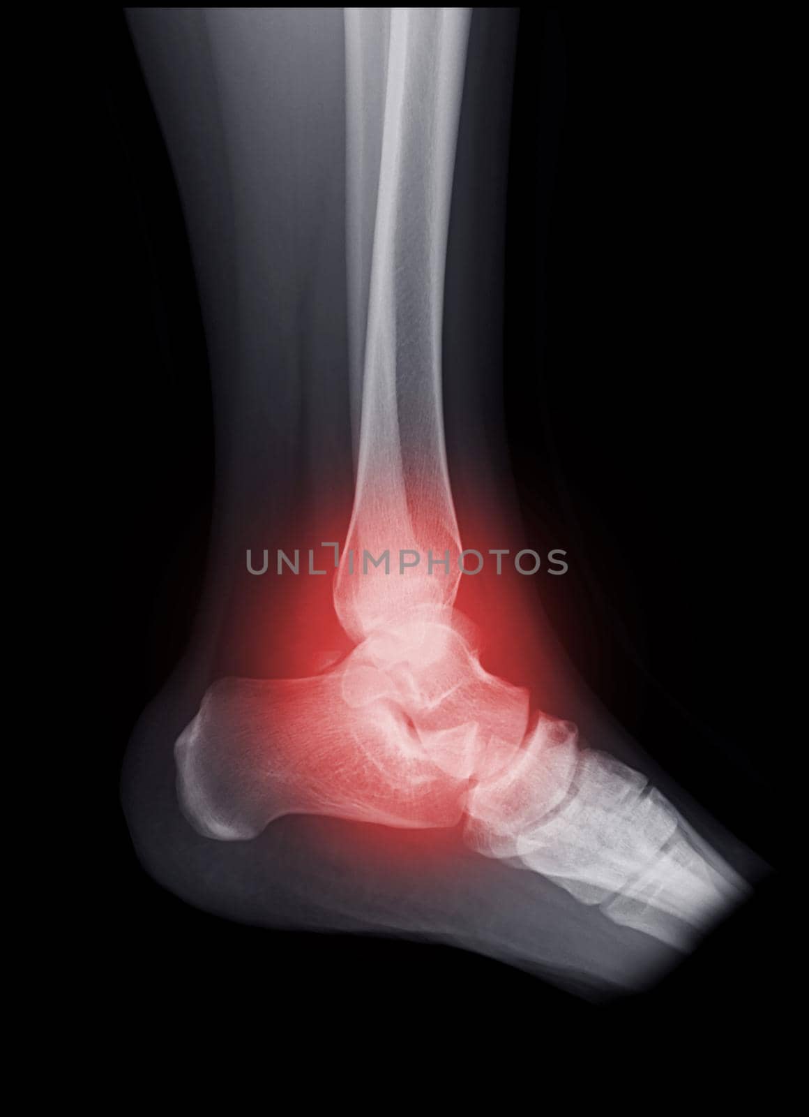 X-ray image of ankle joint for diagnosis fracture tibia and fibula bone.