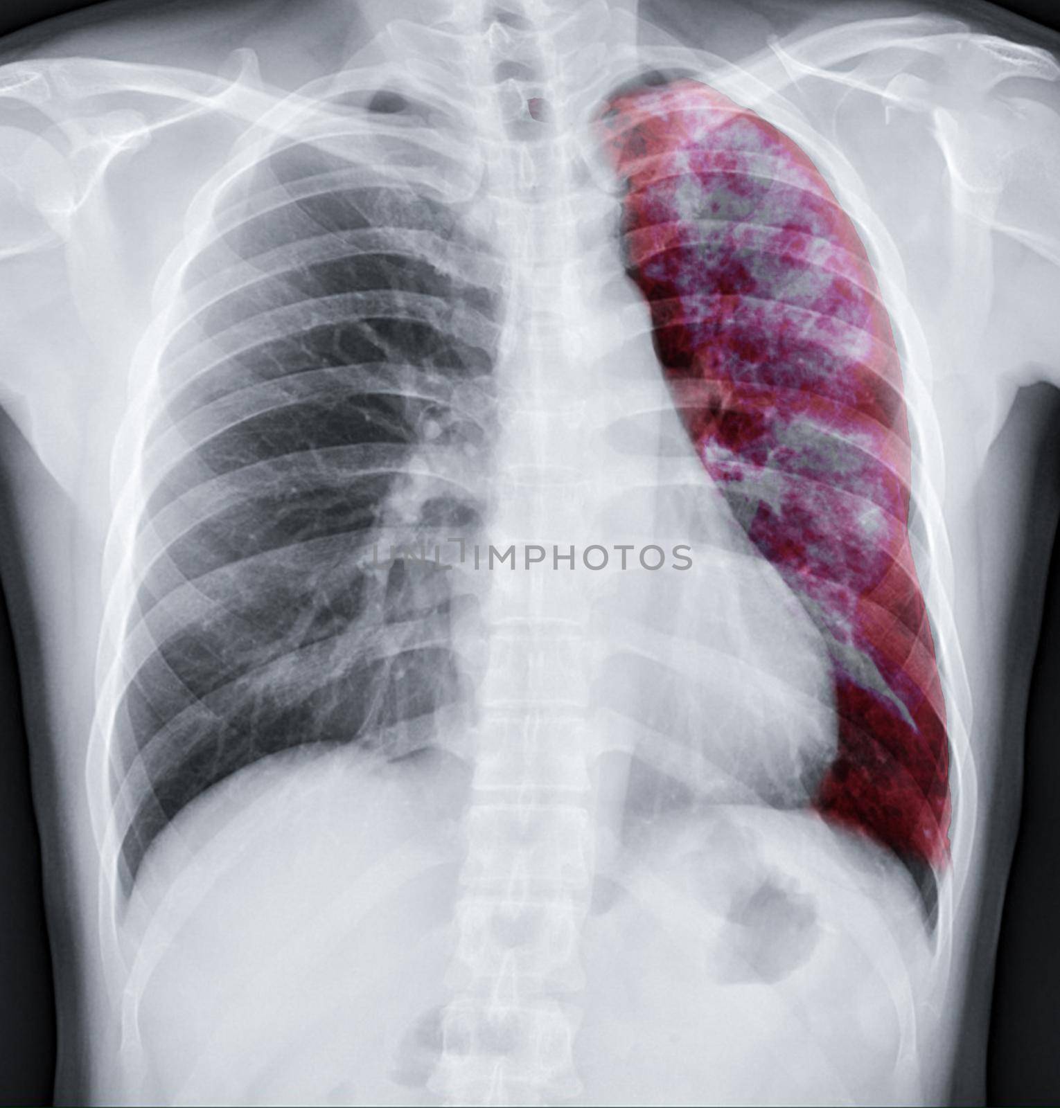 Chest xray fusion with Lung 3D rendering image for diagnosis TB,tuberculosis and covid-19 from CT-Scanner 3D.