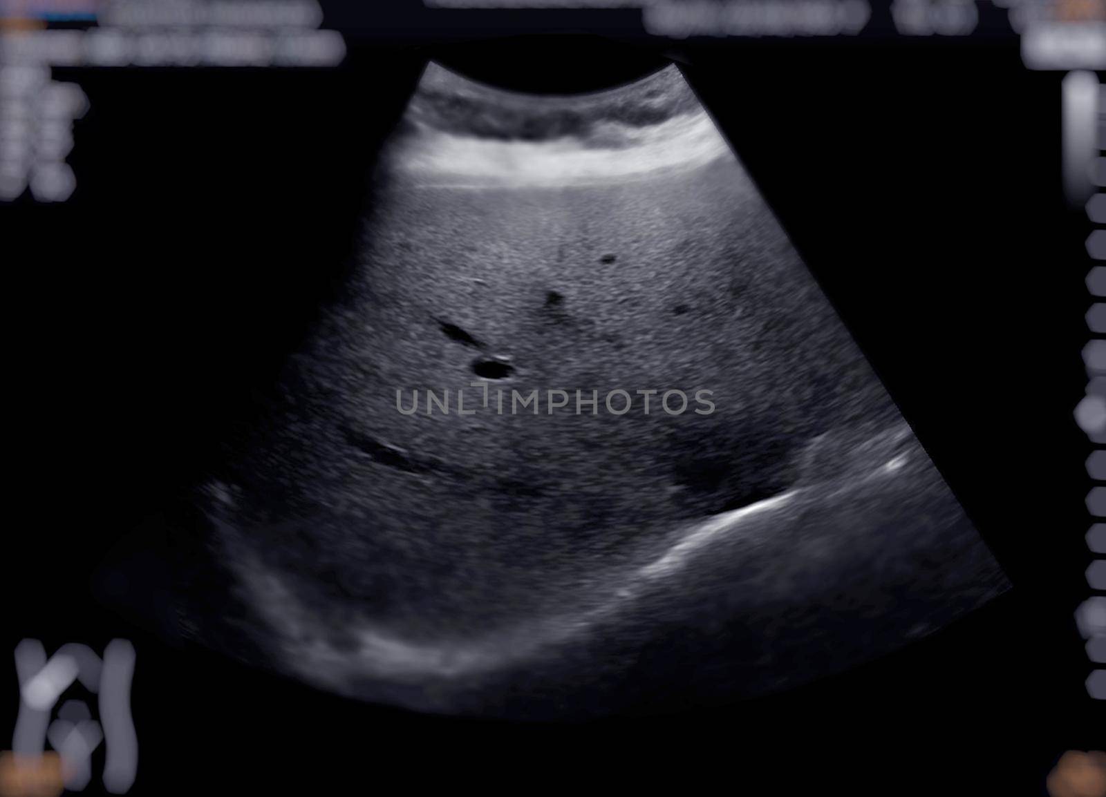 Ultrasound upper abdomen showing Liver and gall bladder for screening hepatic cell carcinoma and gallstone.