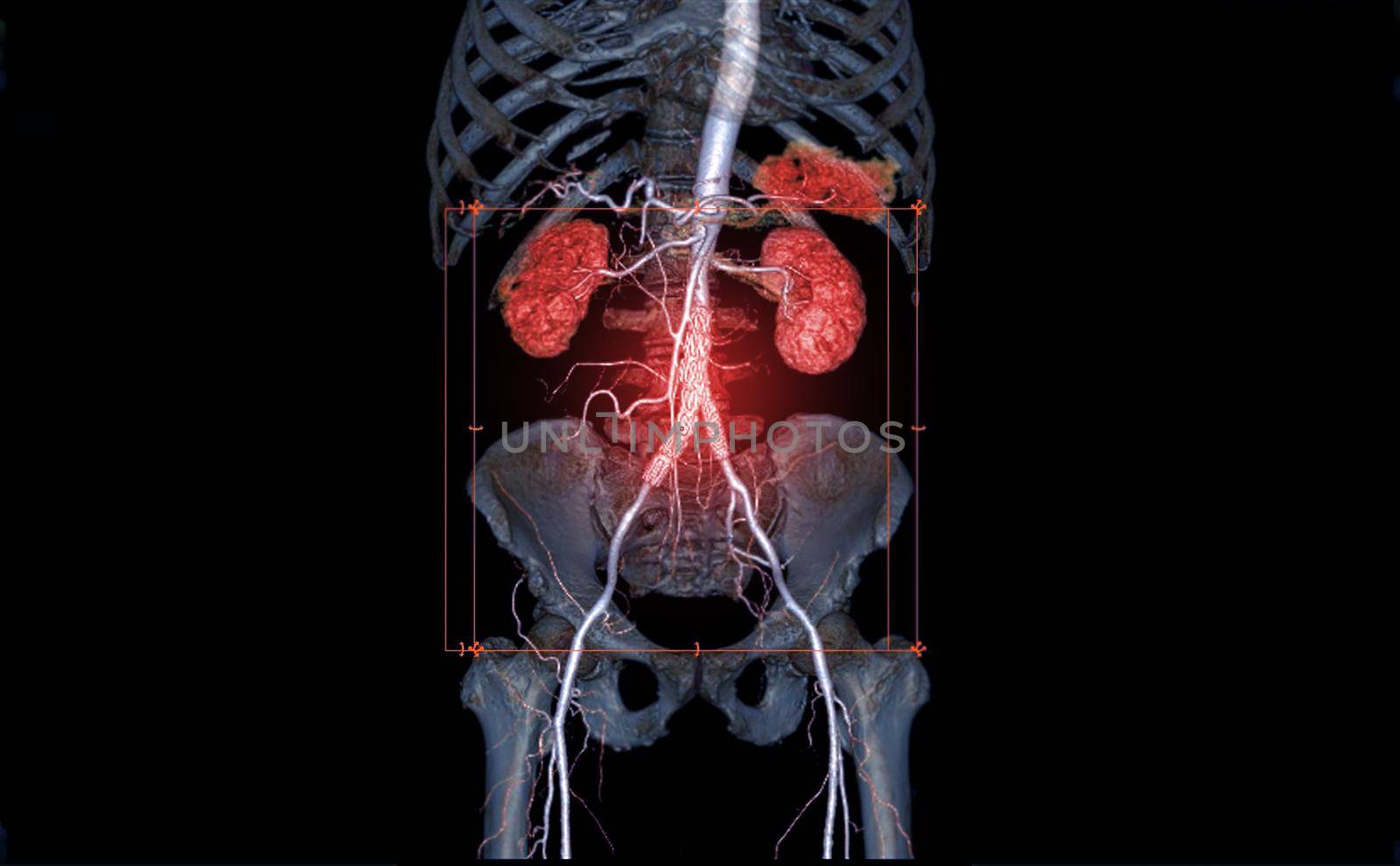 CTA Whole Aorta 3D rendering image of the arteries in the whole body with abdominal aorta stent graft generate from CT scanner