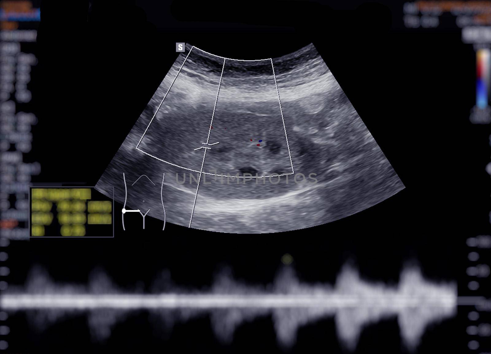 Ultrasound upper abdomen showing kidney.