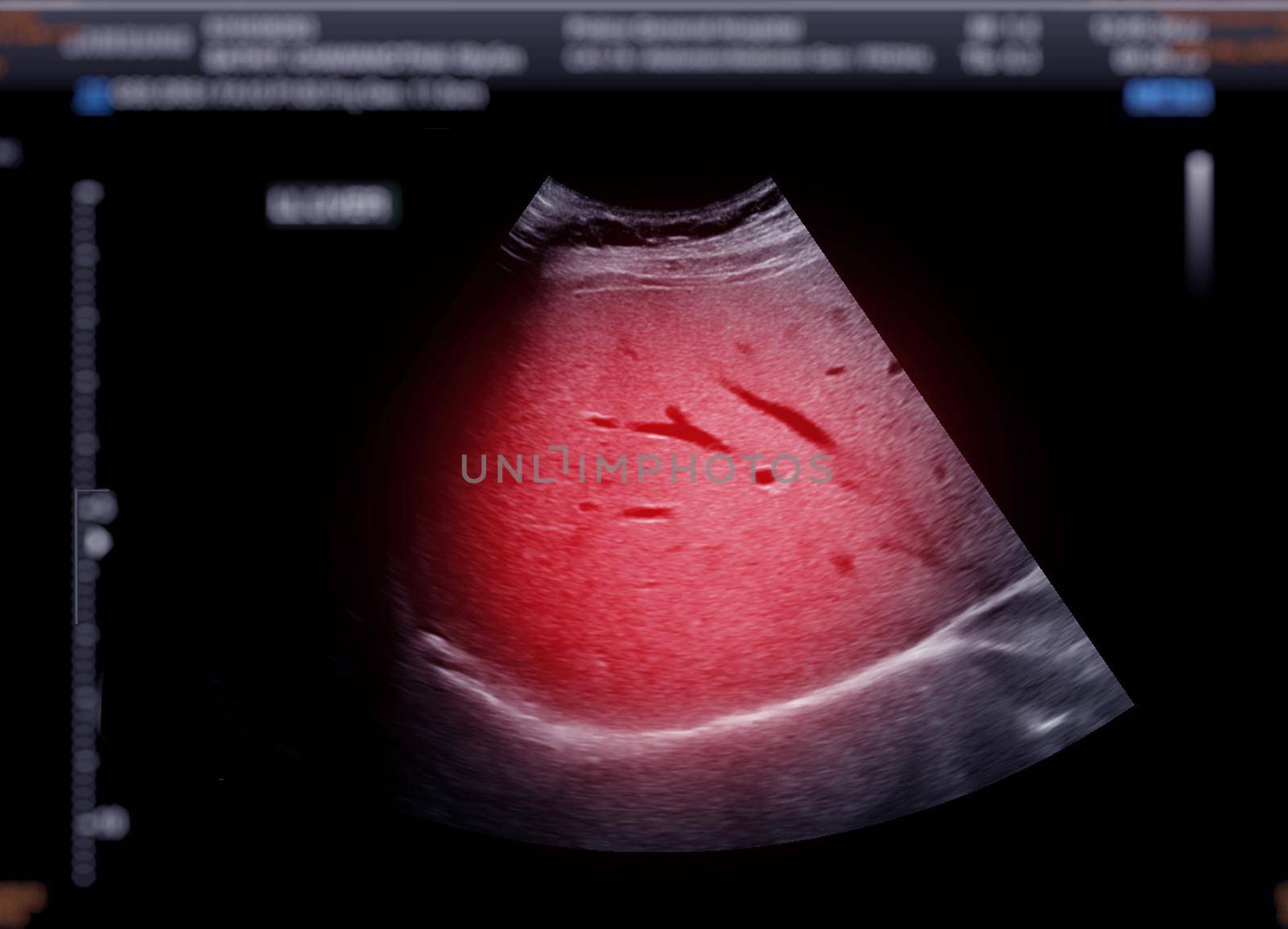 Ultrasound upper abdomen showing liver.