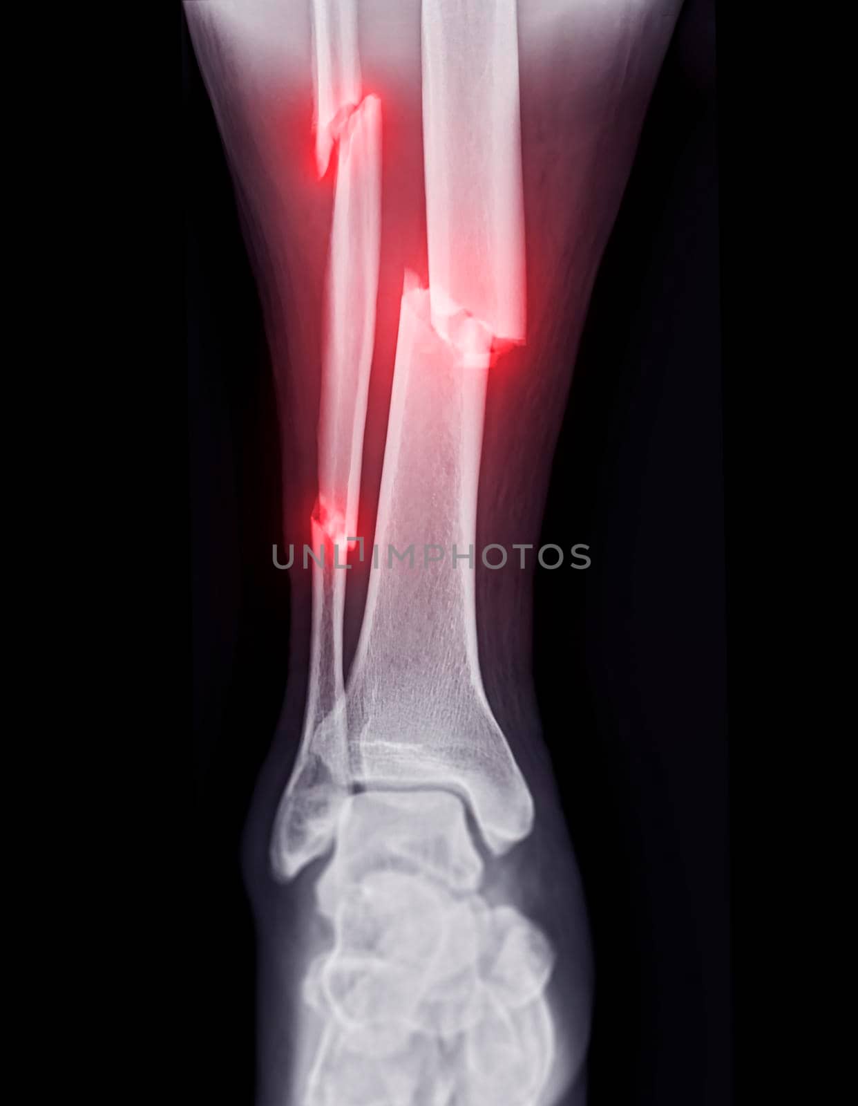 X-ray image of ankle joint showing fracture tibia and fibula bone.'