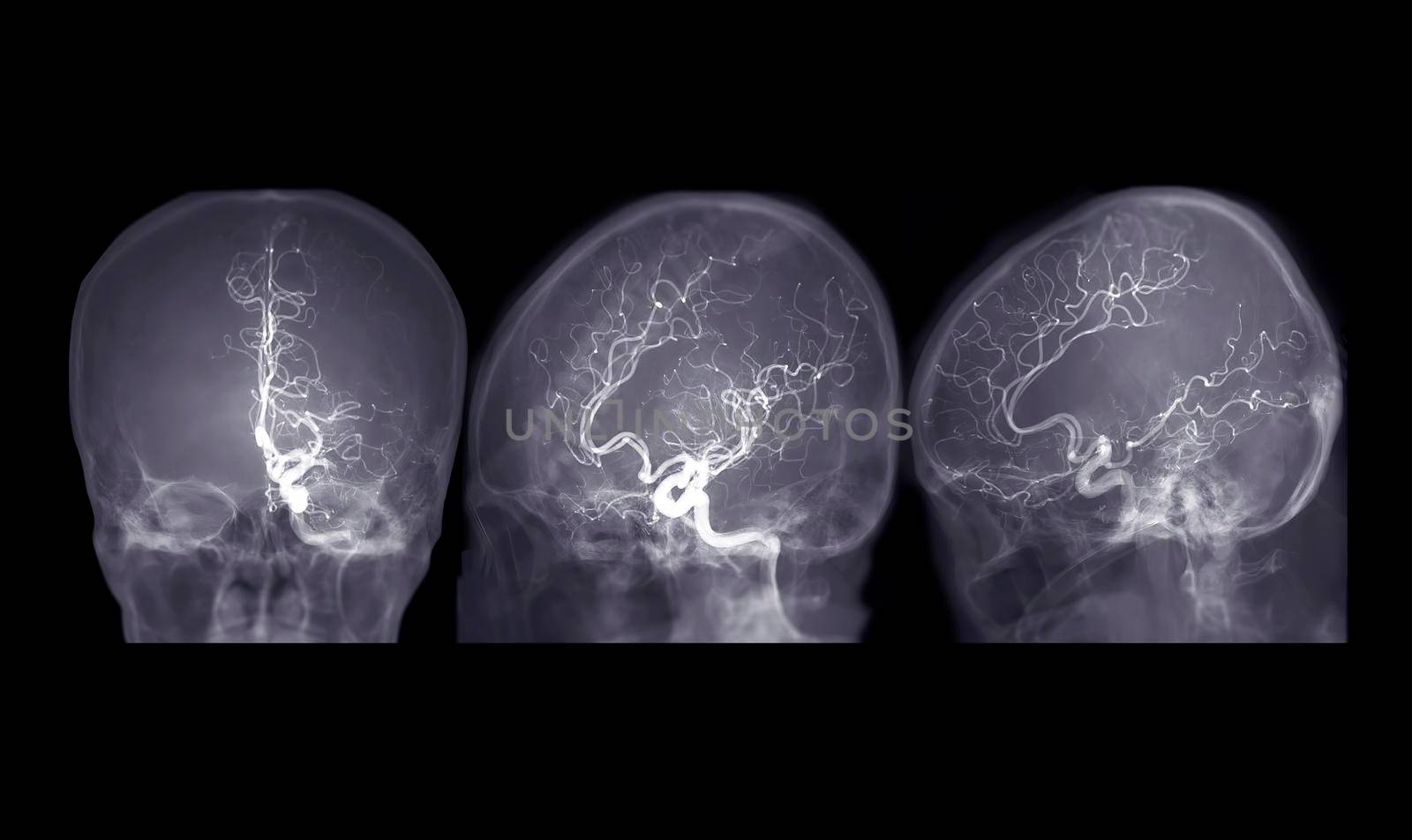 Cerebral angiography AP,Oblique and Lateral view image from Fluoroscopy in intervention radiology showing cerebral artery. by samunella