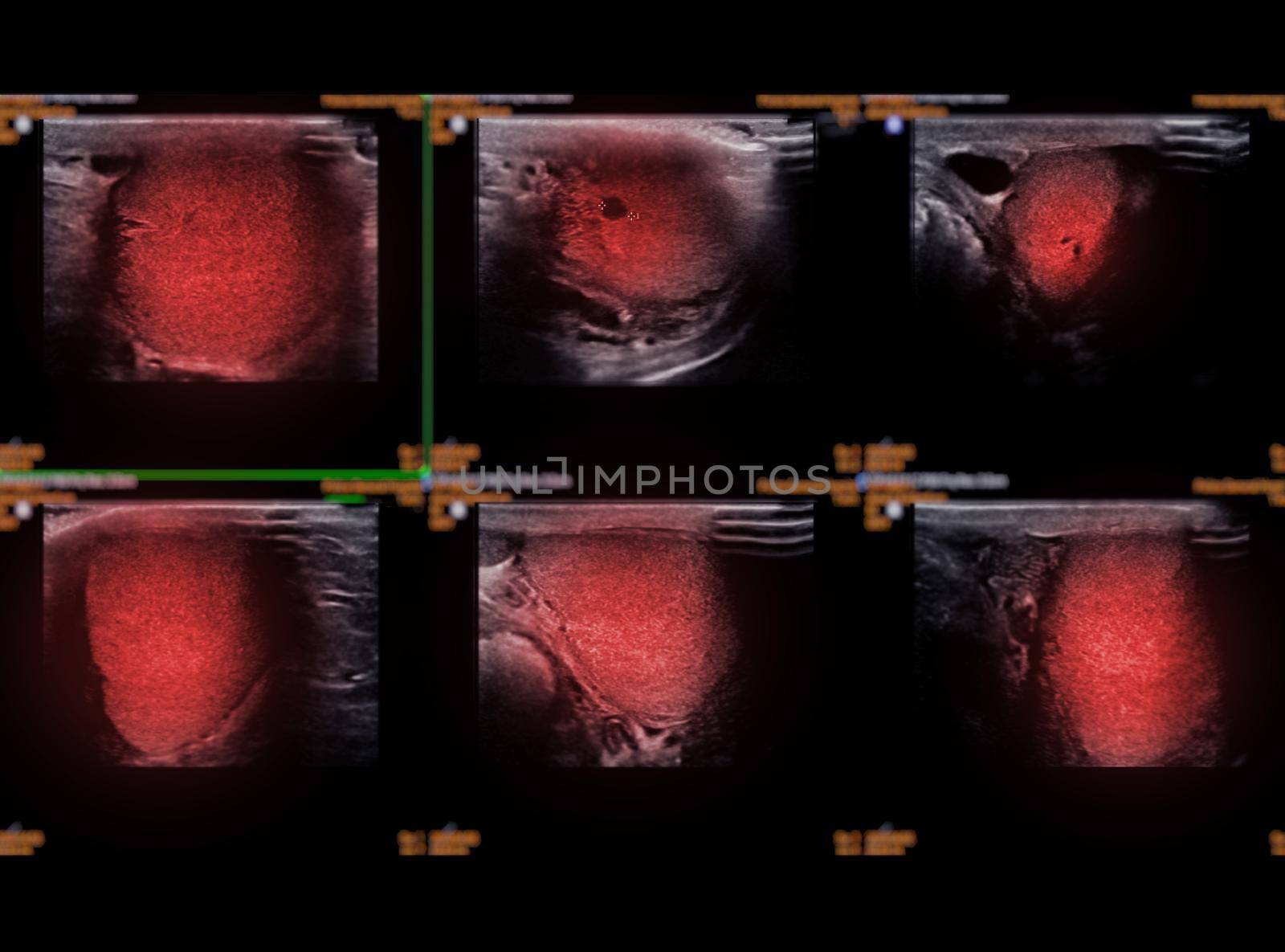Ultrasonography of thyroid gland for diagnostics of the thyroid gland. by samunella