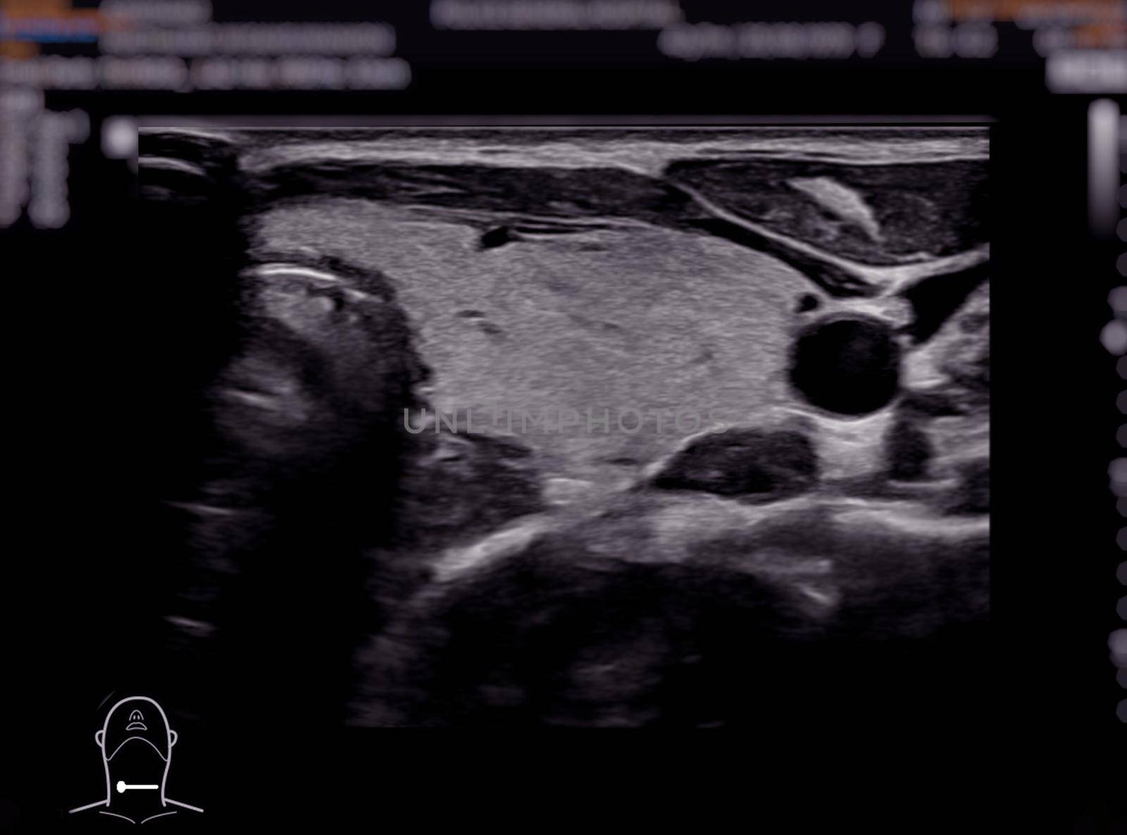 Ultrasonography of thyroid gland for diagnostics of the thyroid gland.