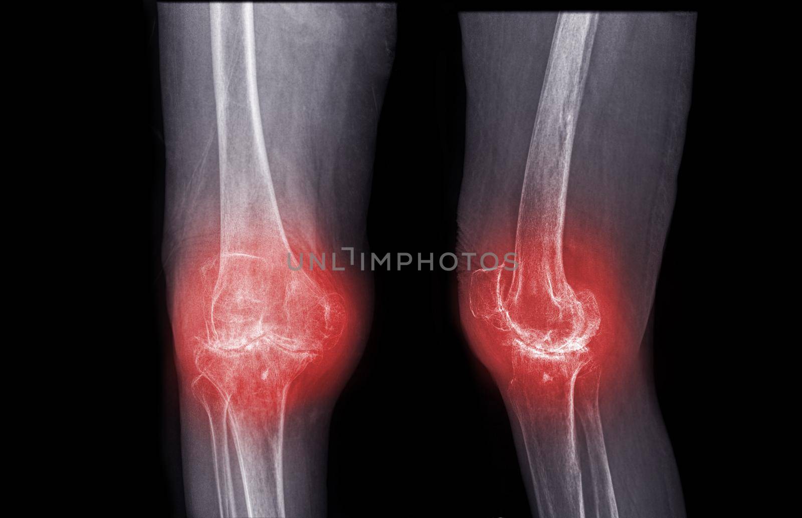 film x-ray knee AP and lateral view of osteoarthritis knee patient and artificial joint .