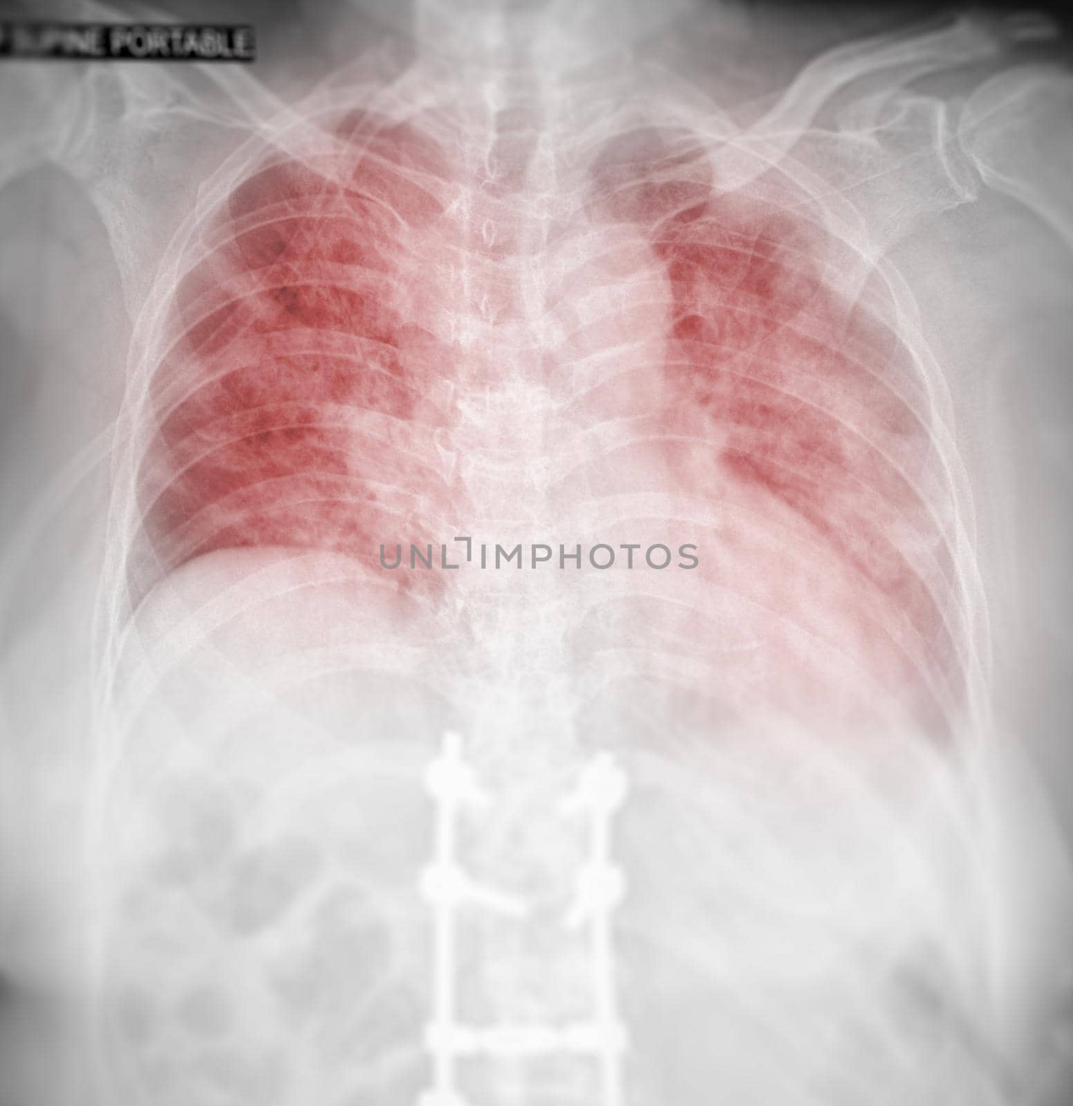 Chest x-ray image for screening diagnosis TB,tuberculosis and covid-19. by samunella