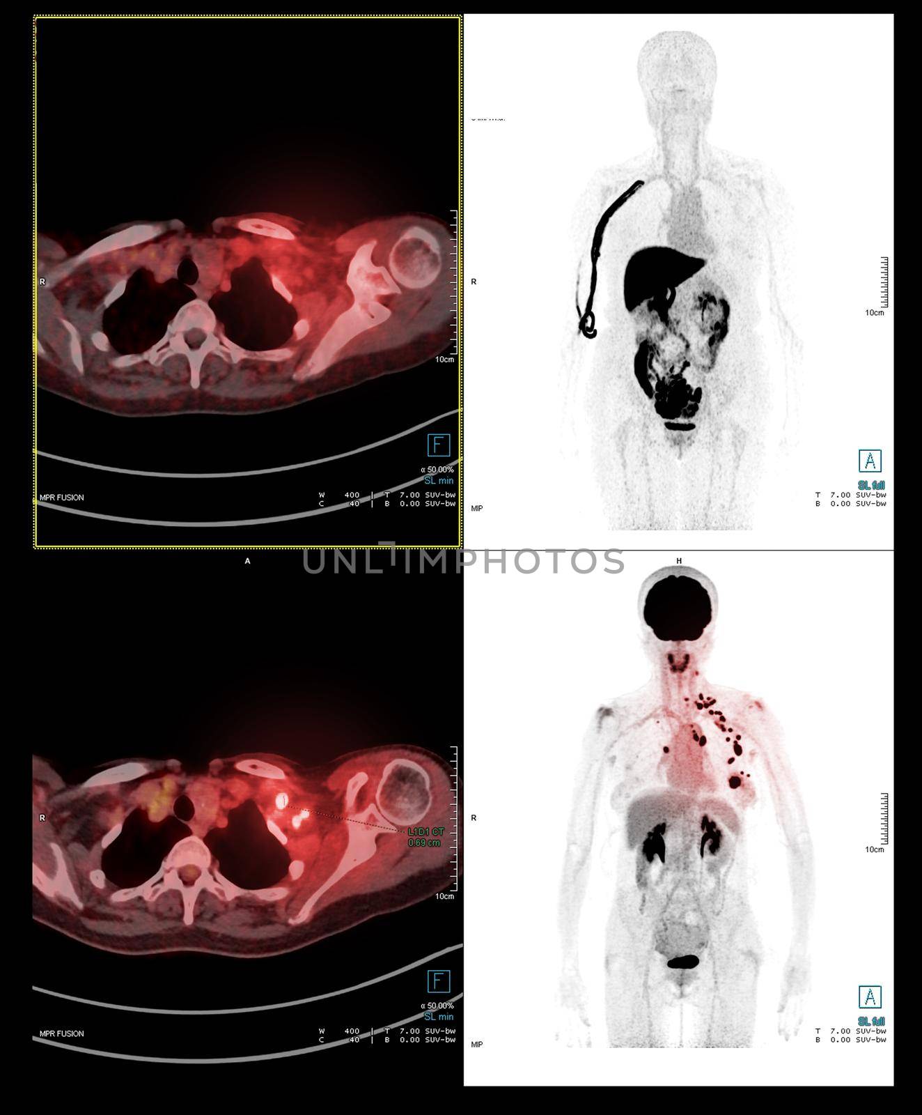 PET Scan image of whole human body for detect cancer recurrence after surgery. medical technology concept.