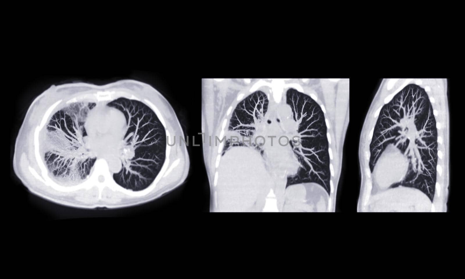 CT scan of Chest or lung axial, coronal and sagittal mip view of lung infection covid-19 with ground glass opacity .