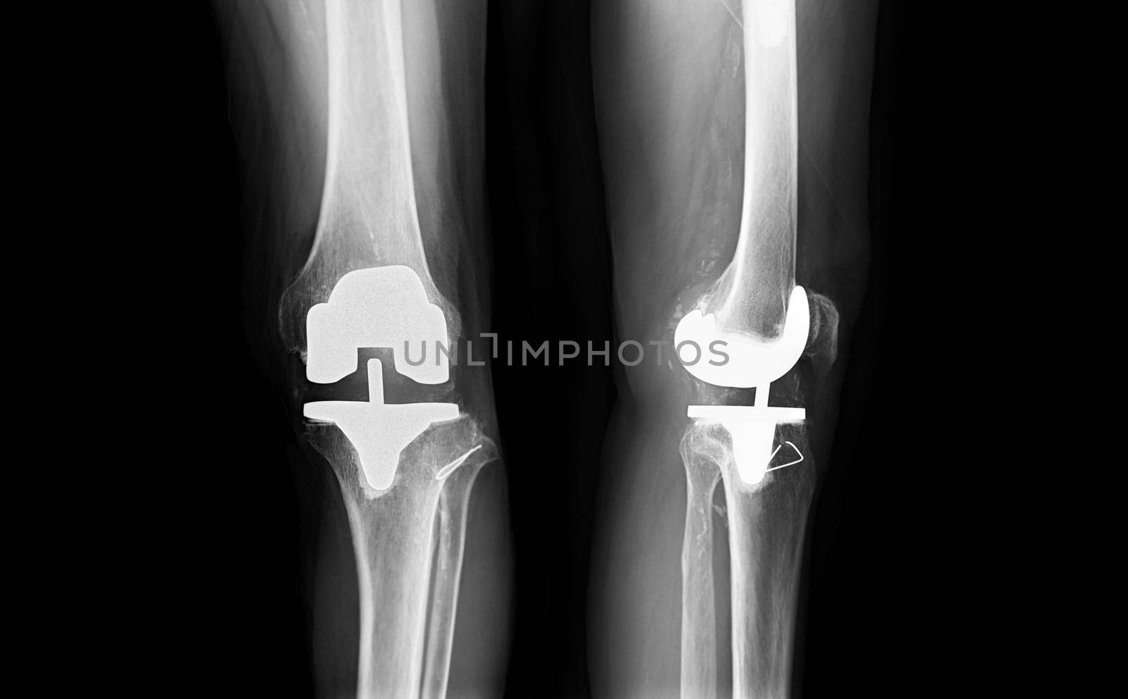 film x-ray Left knee AP and lateral view of osteoarthritis knee patient and artificial joint with Knee Replacement.