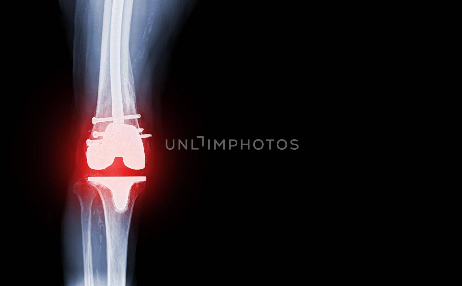 film x-ray knee AP view of osteoarthritis knee patient and artificial joint with Knee Replacement.