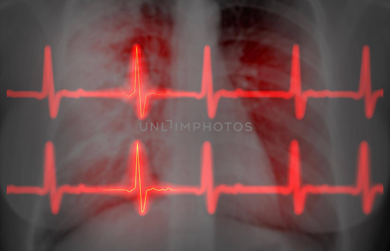CHEST X-ray with EKG 3D rendering image for diagnosis of vessel coronary artery stenosis .