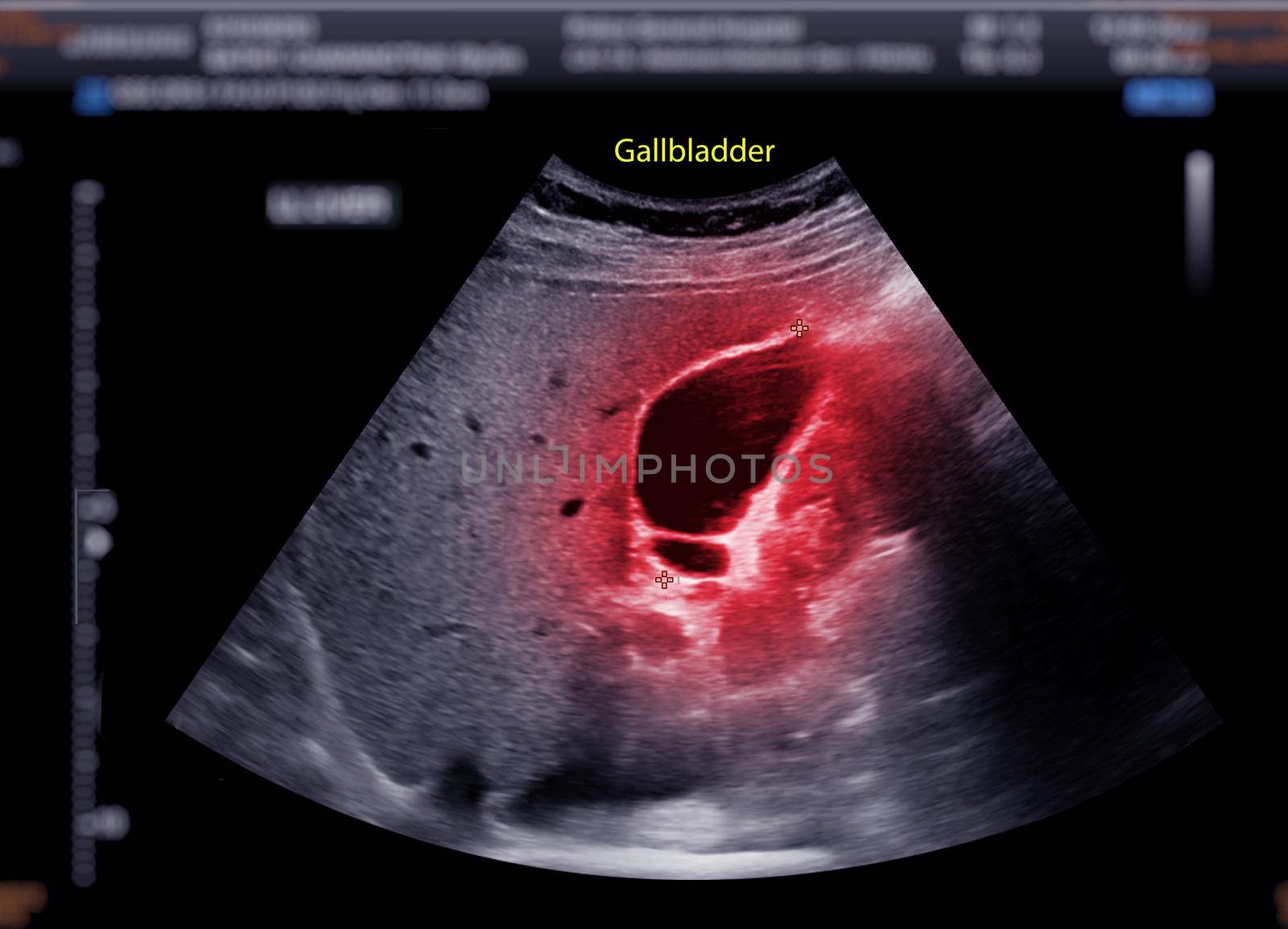 Ultrasound upper abdomen showing gallbladder for diagnosis gallbladder stone. by samunella