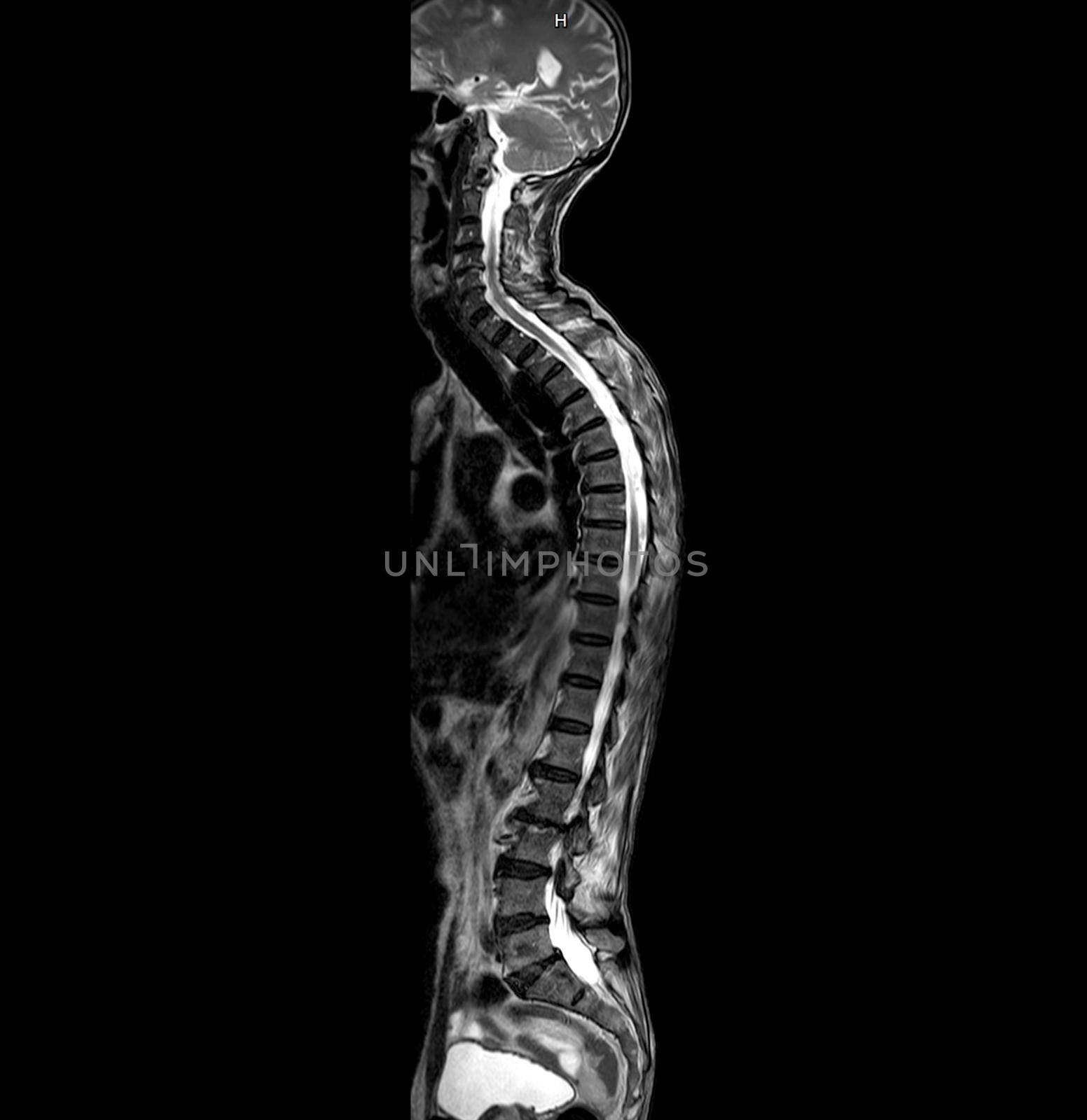 MRI of whole spine T2W sagittal plane for diagnostic Spinal Cord Compression.