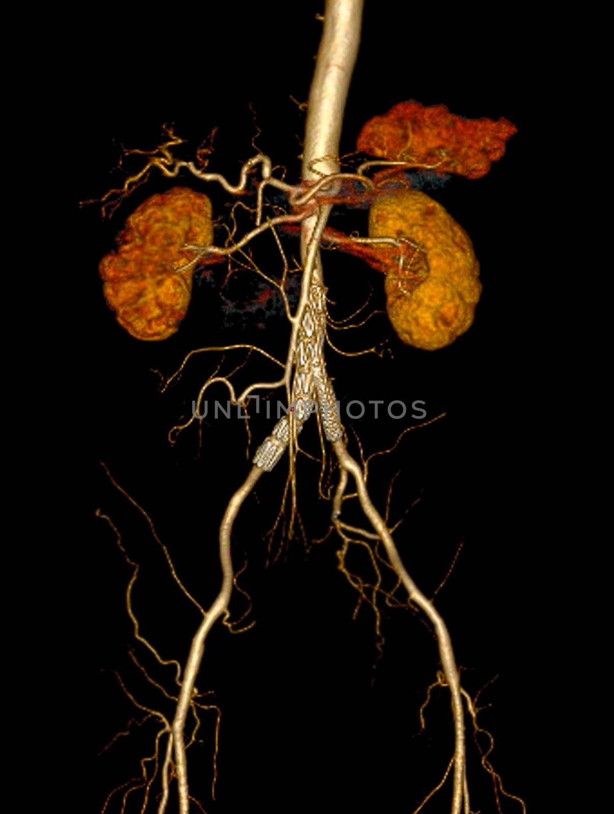 CTA Whole Aorta 3D rendering image of the arteries in the whole body with abdominal aorta stent graft generate from CT scanner