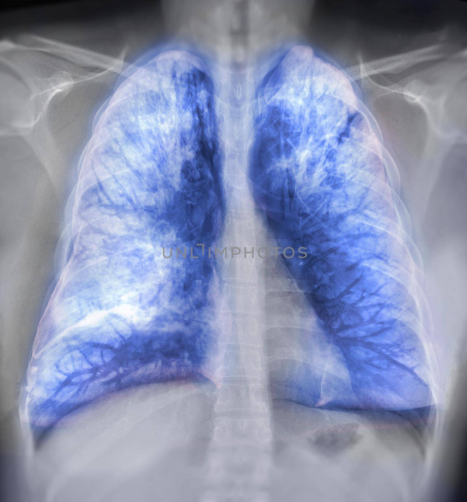 Lung 3D rendering image for diagnosis TB,tuberculosis and covid-19 from CT-Scanner 3D.