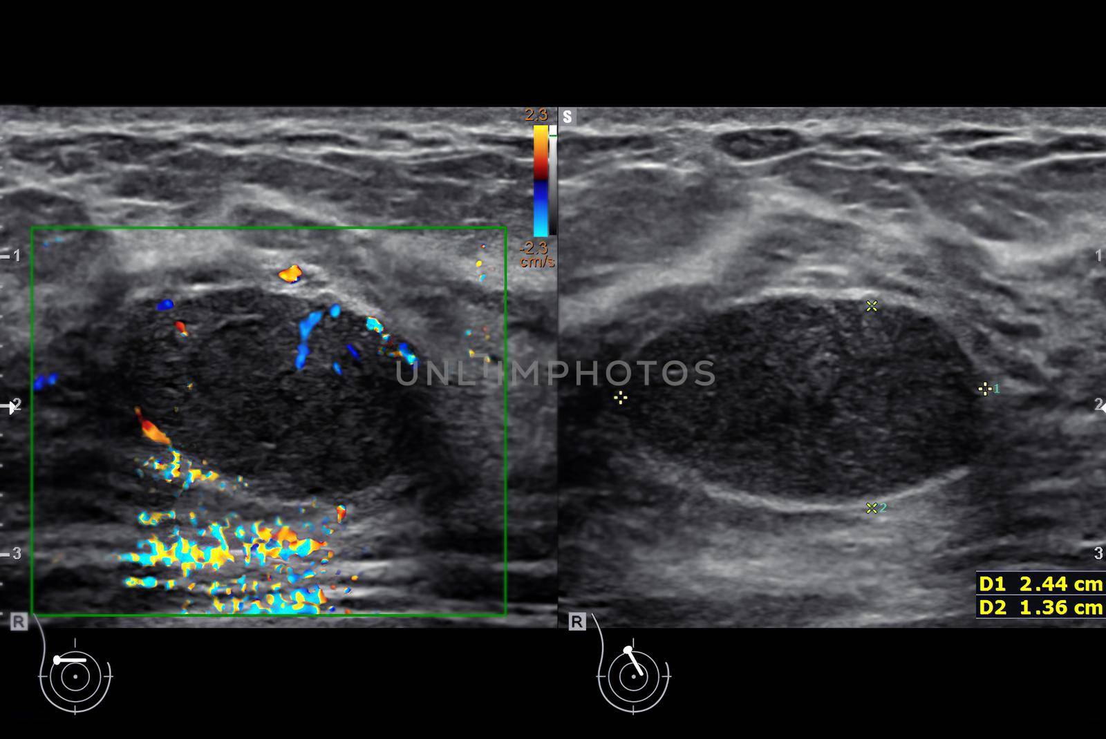 ultrasound breast of Patient after mammogram for diagnonsis Breast cancer in women isolated on black background.