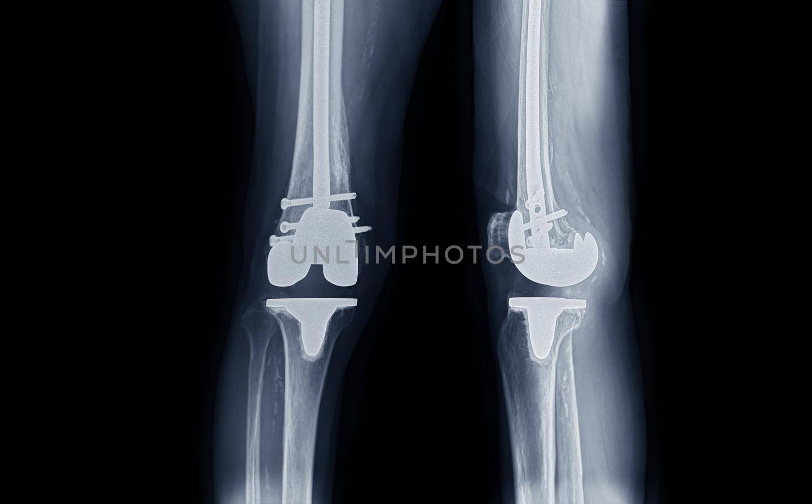 film x-ray Right knee AP and lateral view of osteoarthritis knee patient and artificial joint with Knee Replacement.