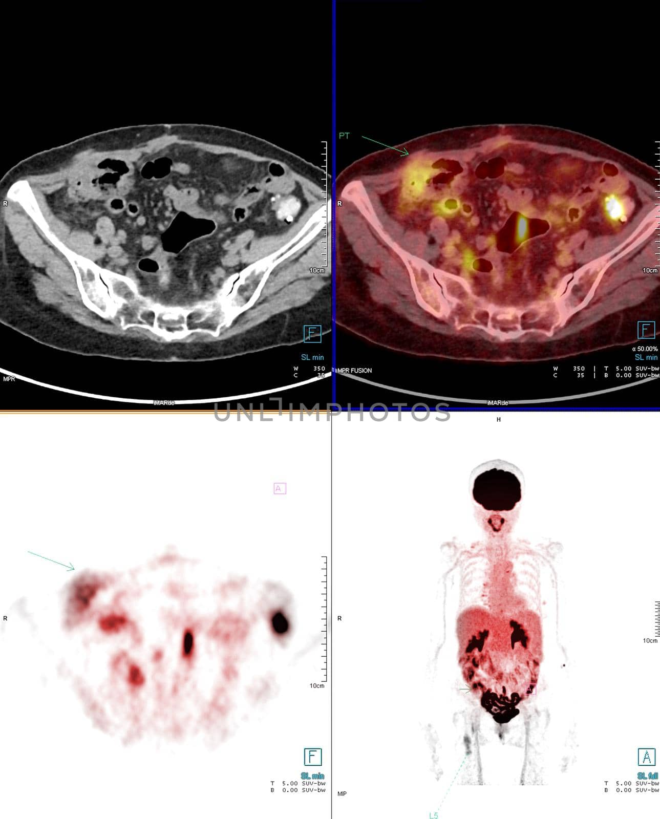 PET Scan image of abdomen for detect lung cancer recurrence after surgery. medical technology concept. by samunella