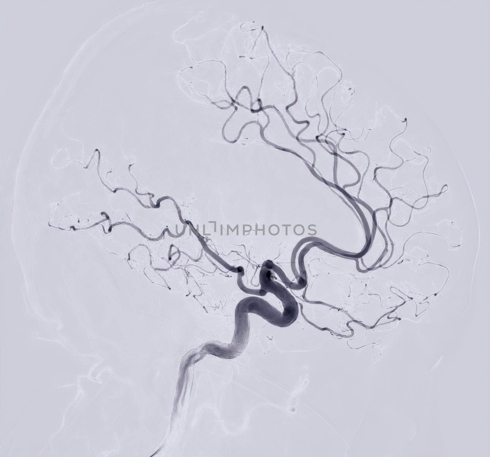 Cerebral angiography Lateral view image from Fluoroscopy in intervention radiology showing cerebral artery. by samunella