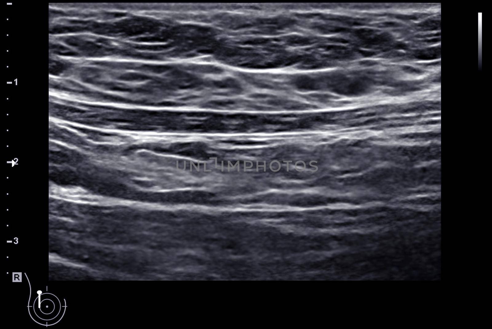 ultrasound breast of Patient after mammogram for diagnonsis Breast cancer in women isolated on black background.