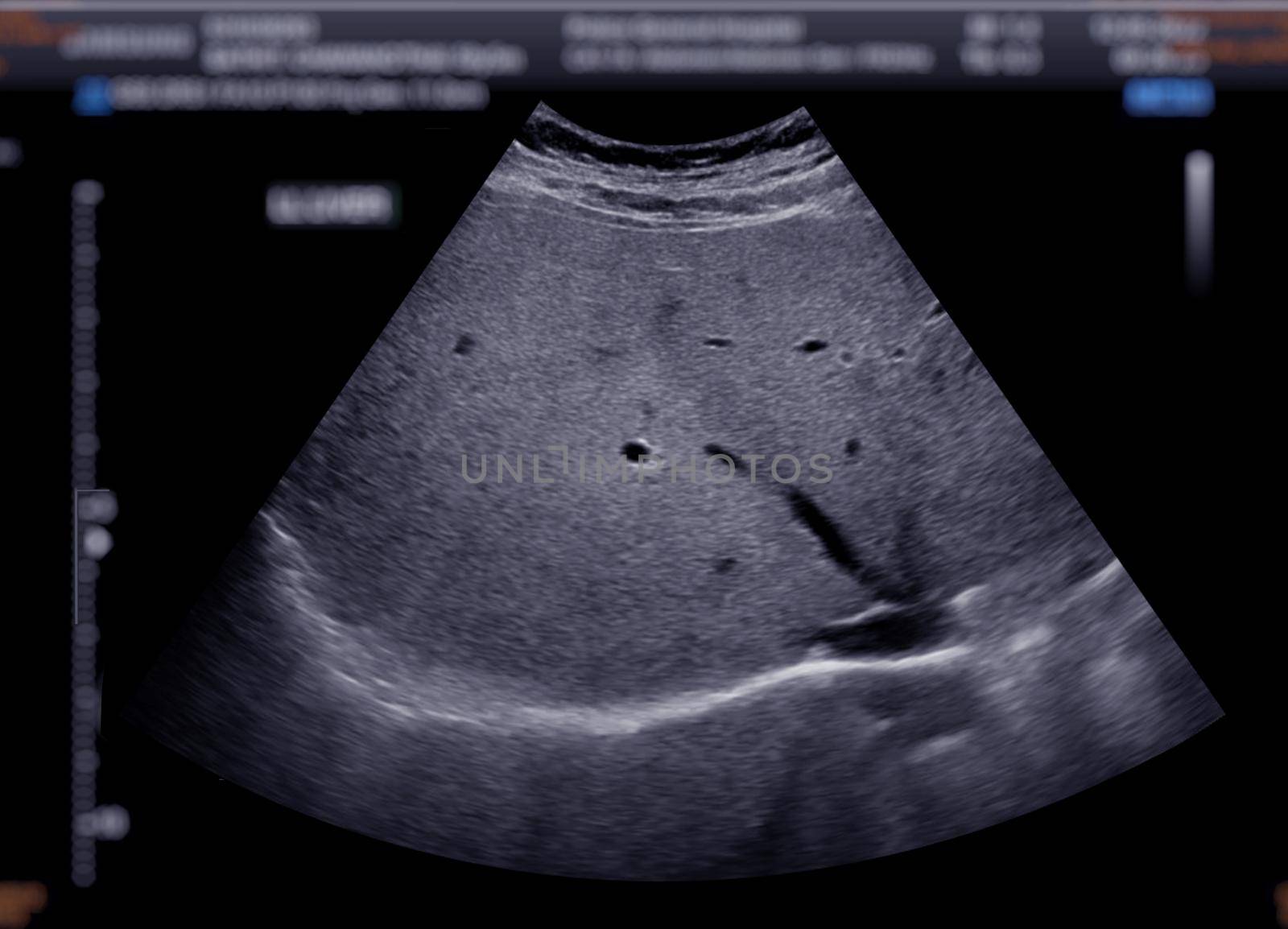 Ultrasound upper abdomen showing liver.