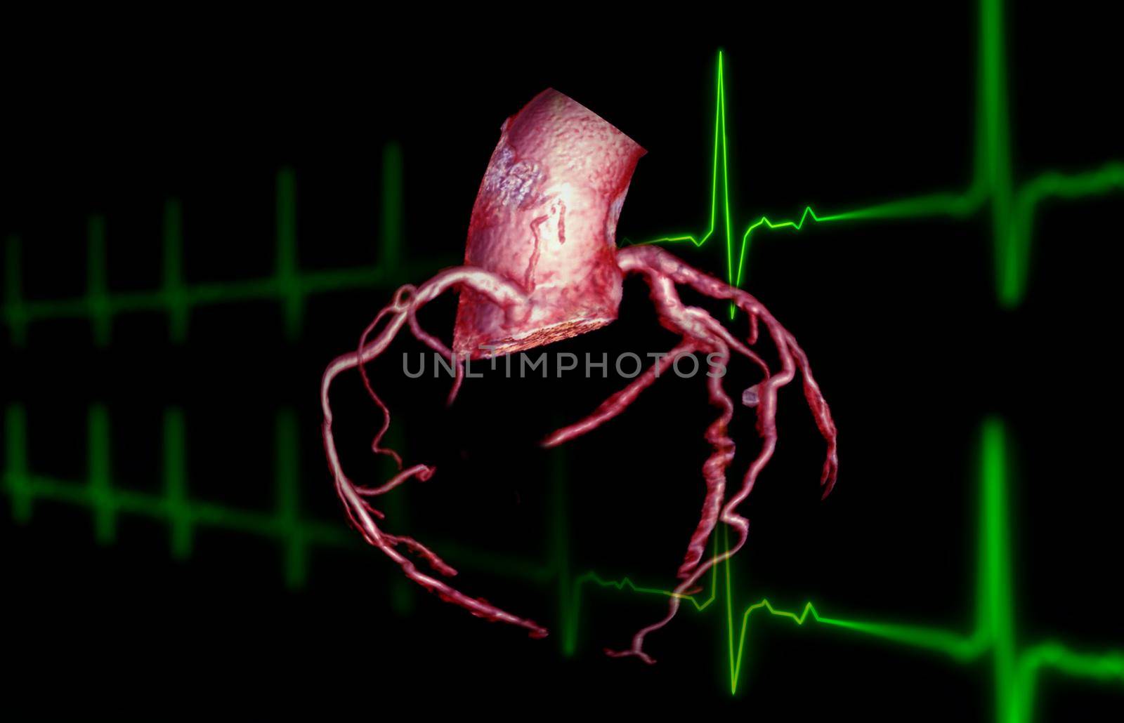 CTA Coronary artery 3D rendering image on the screen for diagnosis of vessel coronary artery stenosis . by samunella