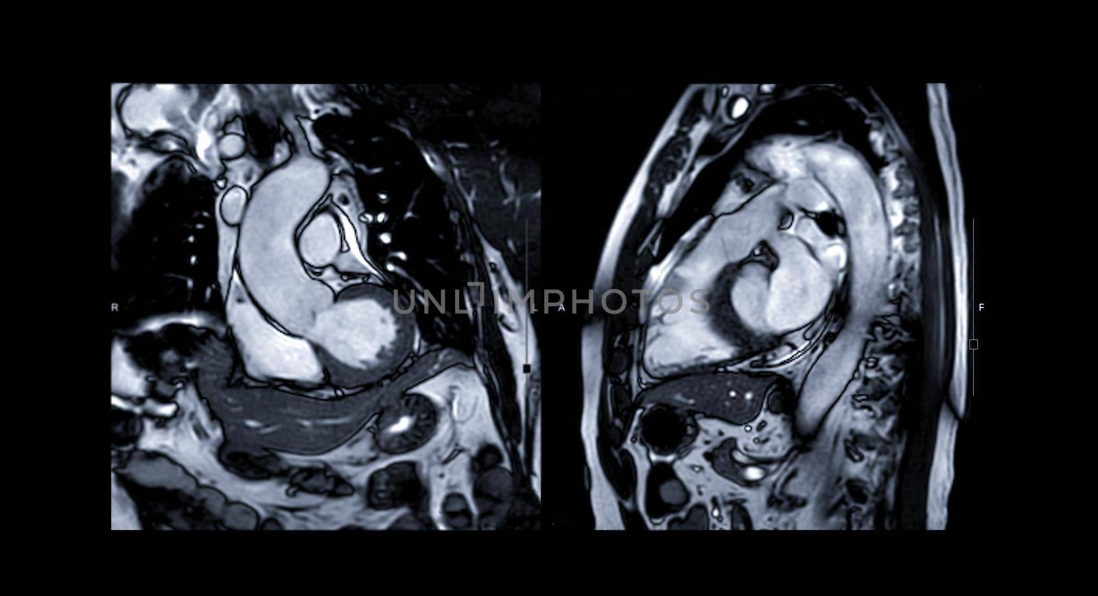 MRI heart or Cardiac MRI ( magnetic resonance imaging ) of heart compare RVOT and LVOT for diagnosis heart disease.