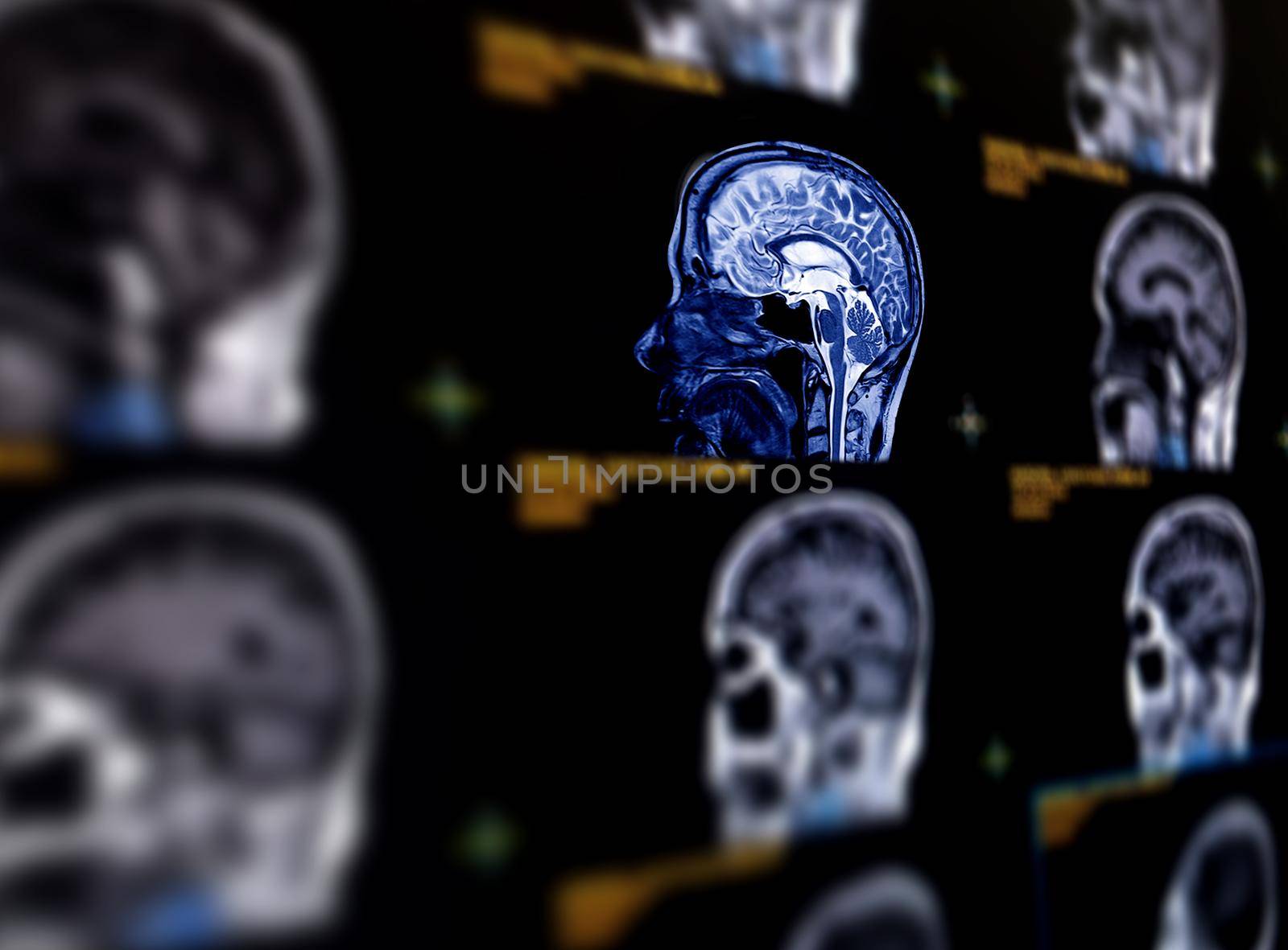 Selective focus of MRI brain sagittal plane for detect a variety of conditions of the brain such as cysts, tumors, bleeding, swelling, developmental and structural abnormalities or infections .