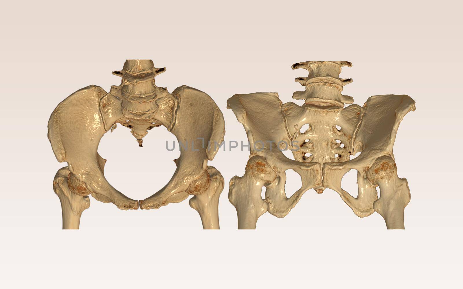 CT Scan of pelvic bone with both hip joint 3D rendering image Inlet and Outlet view . by samunella