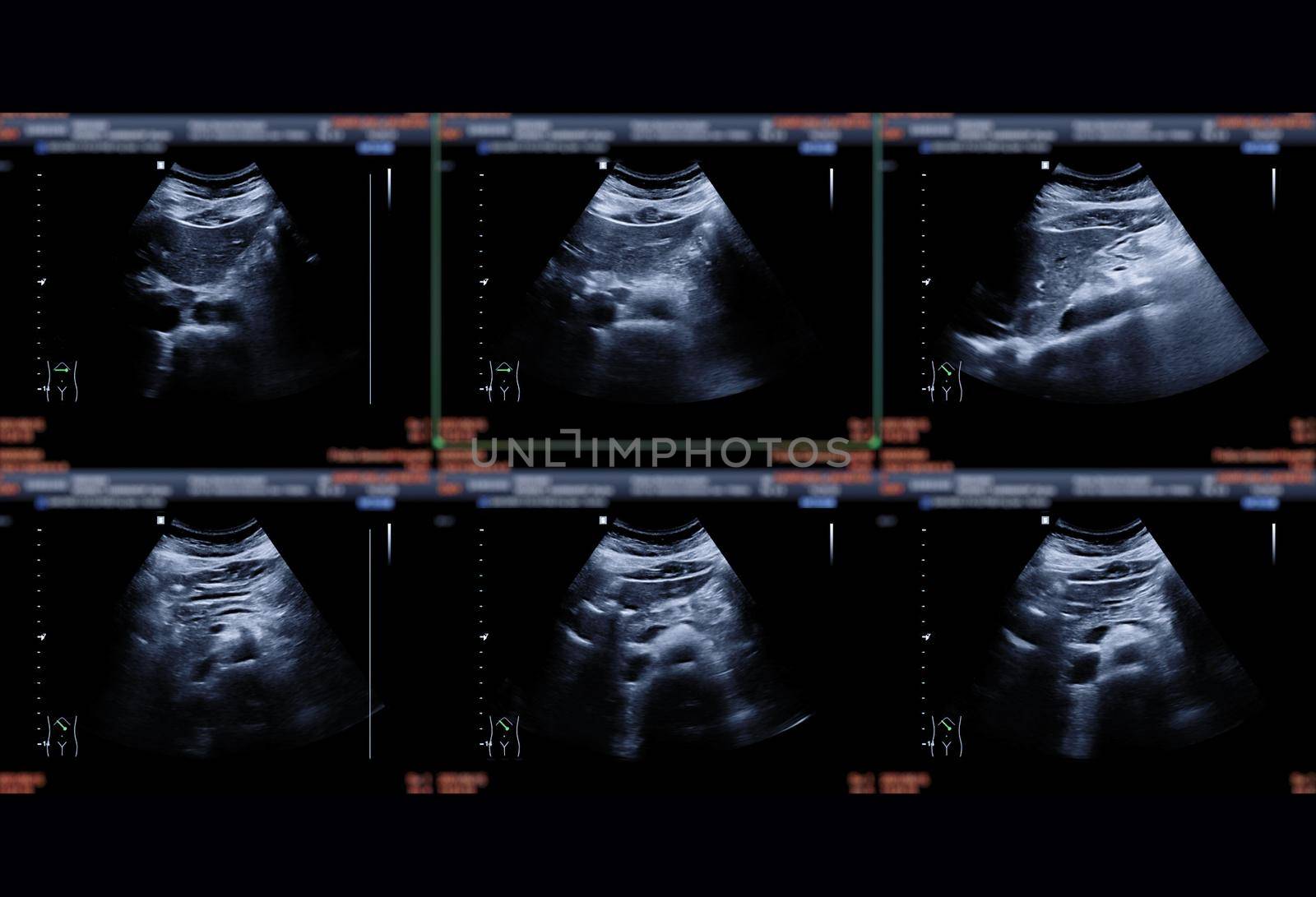 Ultrasound upper abdomen showing Liver ,kidney, pancrease and gall bladder for detect HCC or Gall stone. by samunella