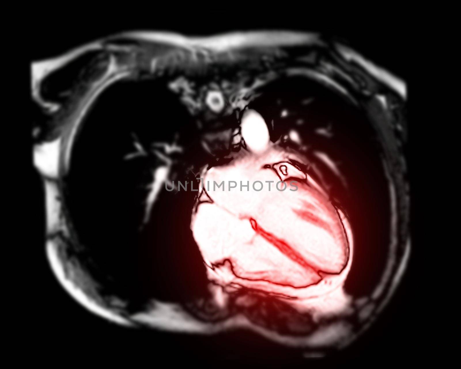 MRI heart or Cardiac MRI ( magnetic resonance imaging ) of heart vertical axis view showing 4 chamber of the heart for diagnosis heart disease. by samunella