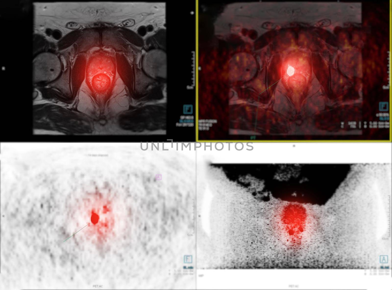 PET/MRI prostate gland fusion imaging in high-grade prostate cancer.