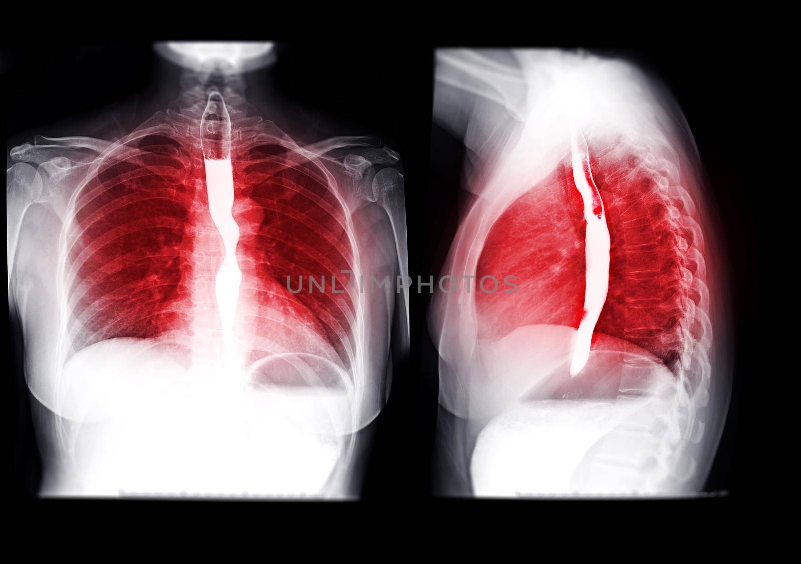 Collection of Esophagram or Barium swallow showing esophagus for diagnosis GERD or Gastroesophageal reflux disease or Esophageal cancer.