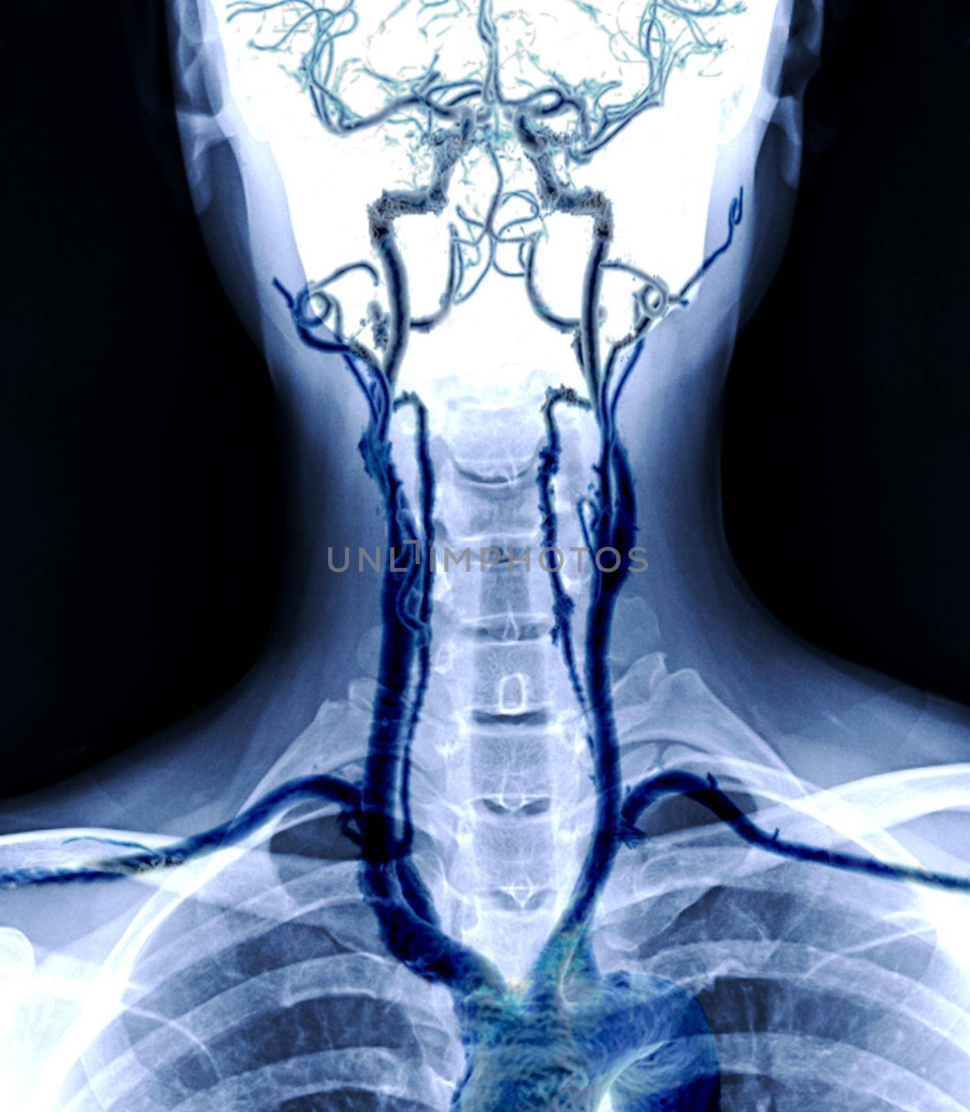 X-ray C-spine or x-ray image of Cervical spine AP view with cta carotid artery . by samunella