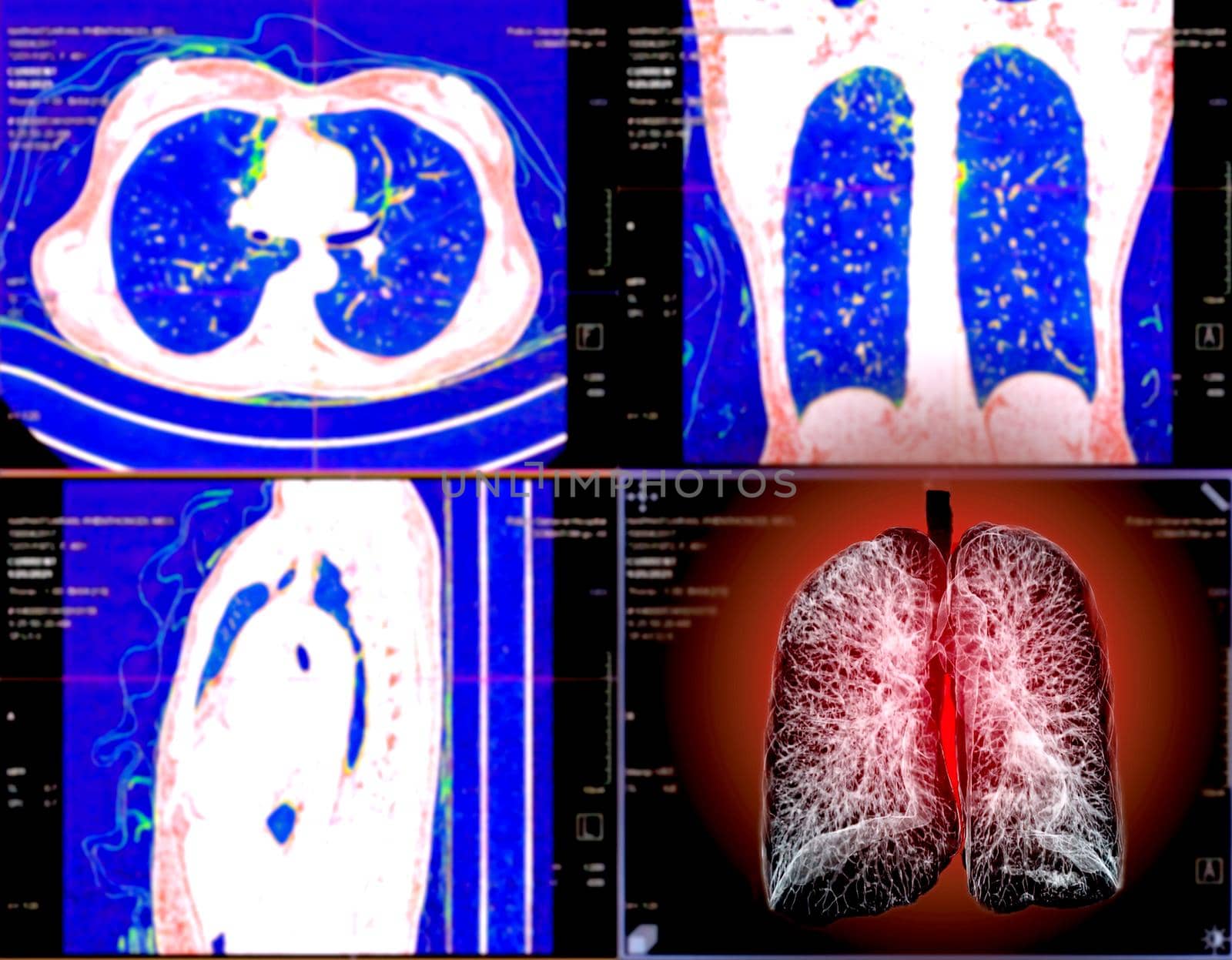 Selective focus of CT Chest or Lung 3D rendering image on the monitor for diagnosis TB,tuberculosis and covid-19 .