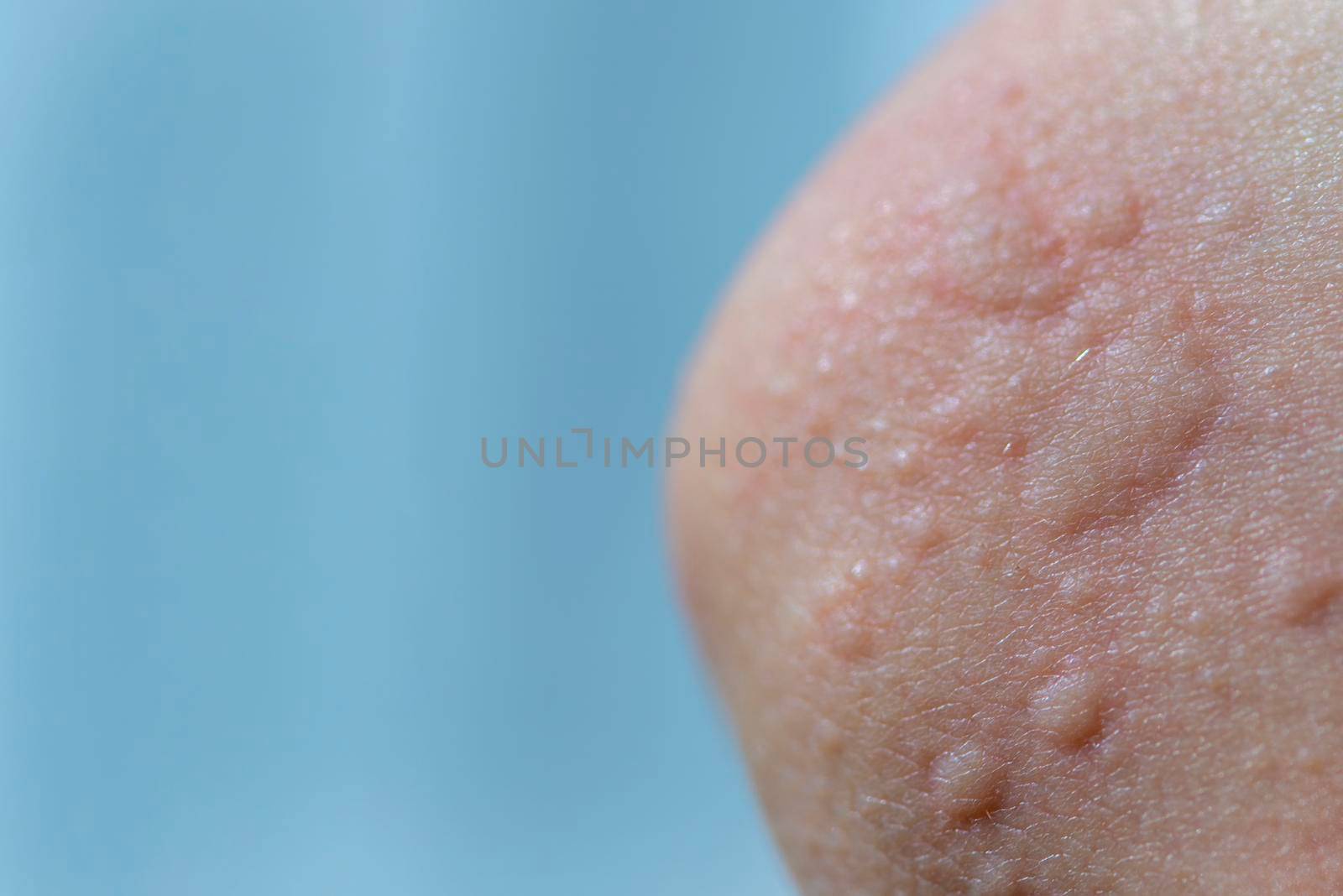 Urticaria on the skin. Red spots of an allergic reaction on the skin of a child. Urticaria symptoms close up by SERSOL