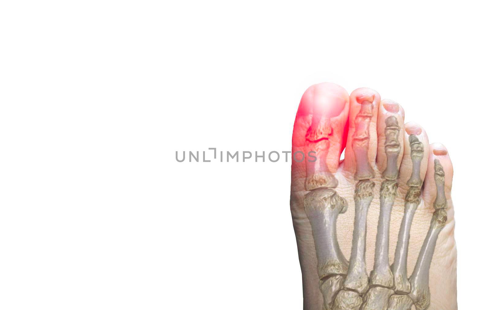 Close up of RIGHT Foot with bone show pain area isolated on a white background. by samunella