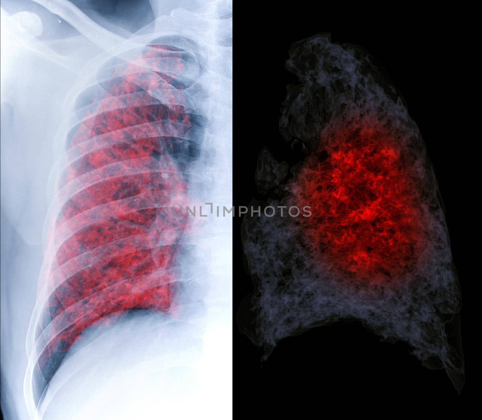 Compare Chest x-ray and CT Chest 3d rendering showing lung infection from covid-19.