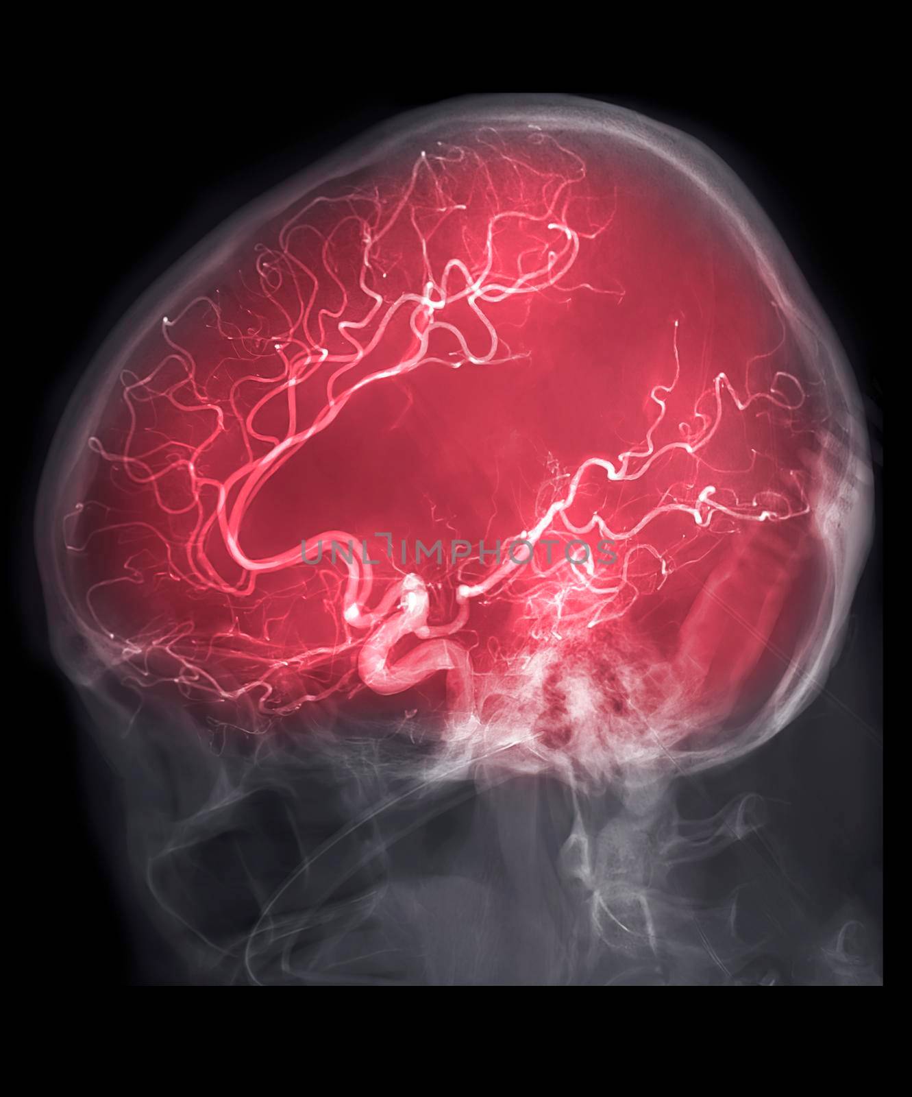 Cerebral angiography Lateral view image from Fluoroscopy in intervention radiology showing cerebral artery.