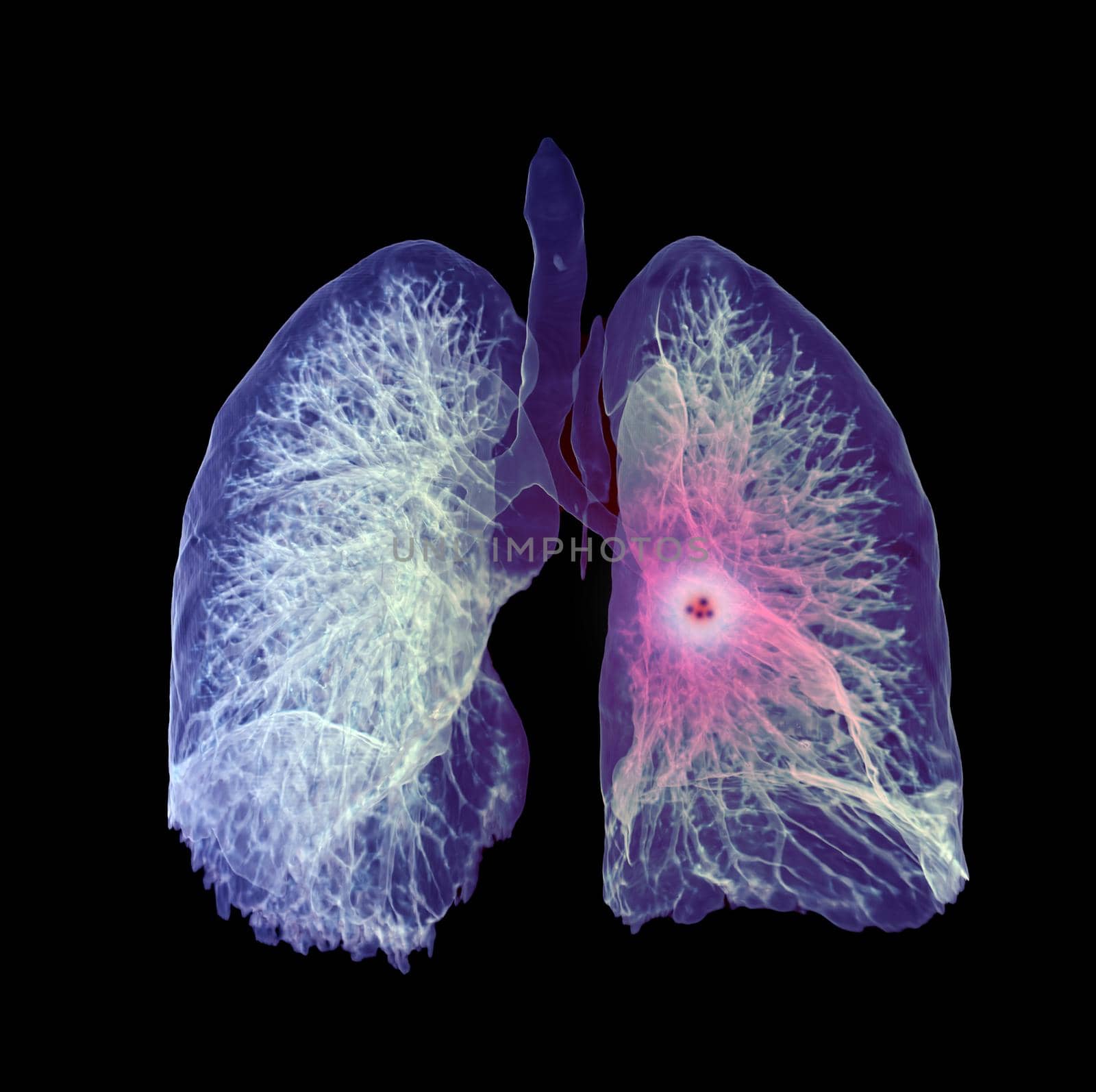 CT Chest or Lung 3D rendering image for diagnosis TB,tuberculosis and covid-19 .