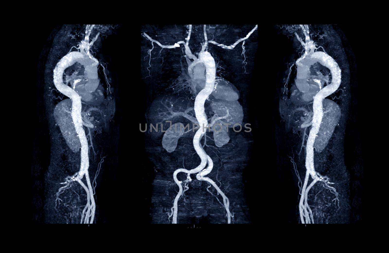 Collection of CTA whoe aorta with curve MPR technique showing abdominal aorta and left, right iliac artery showing aortic dissection .