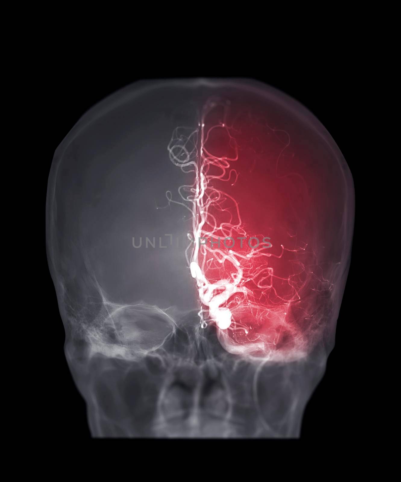 Cerebral angiography AP view image from Fluoroscopy in intervention radiology. by samunella