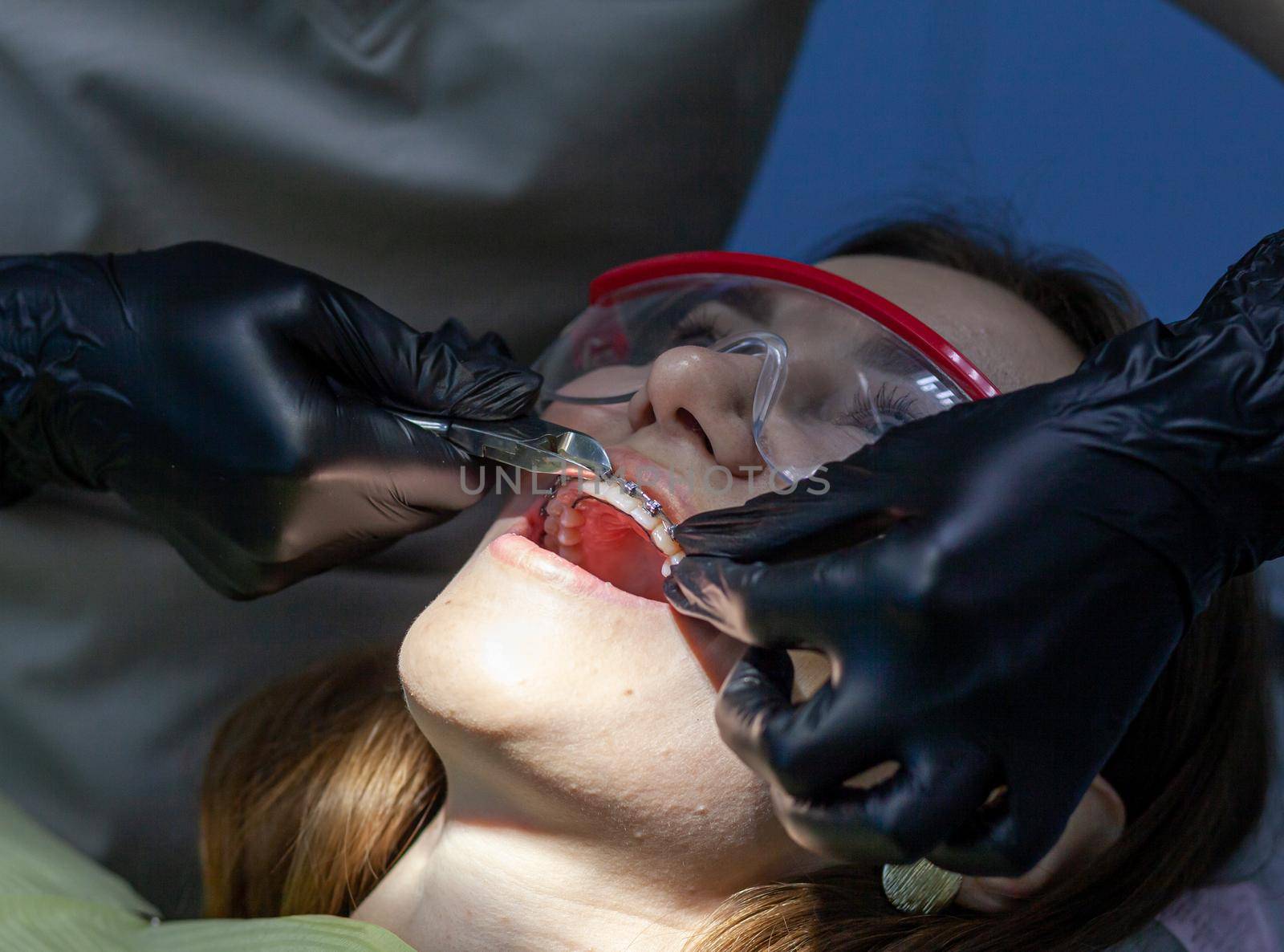 The process of removing braces. A beautiful woman in protective glasses in a dental chair during the procedure of removing braces from teeth. Dentist and assistant working.