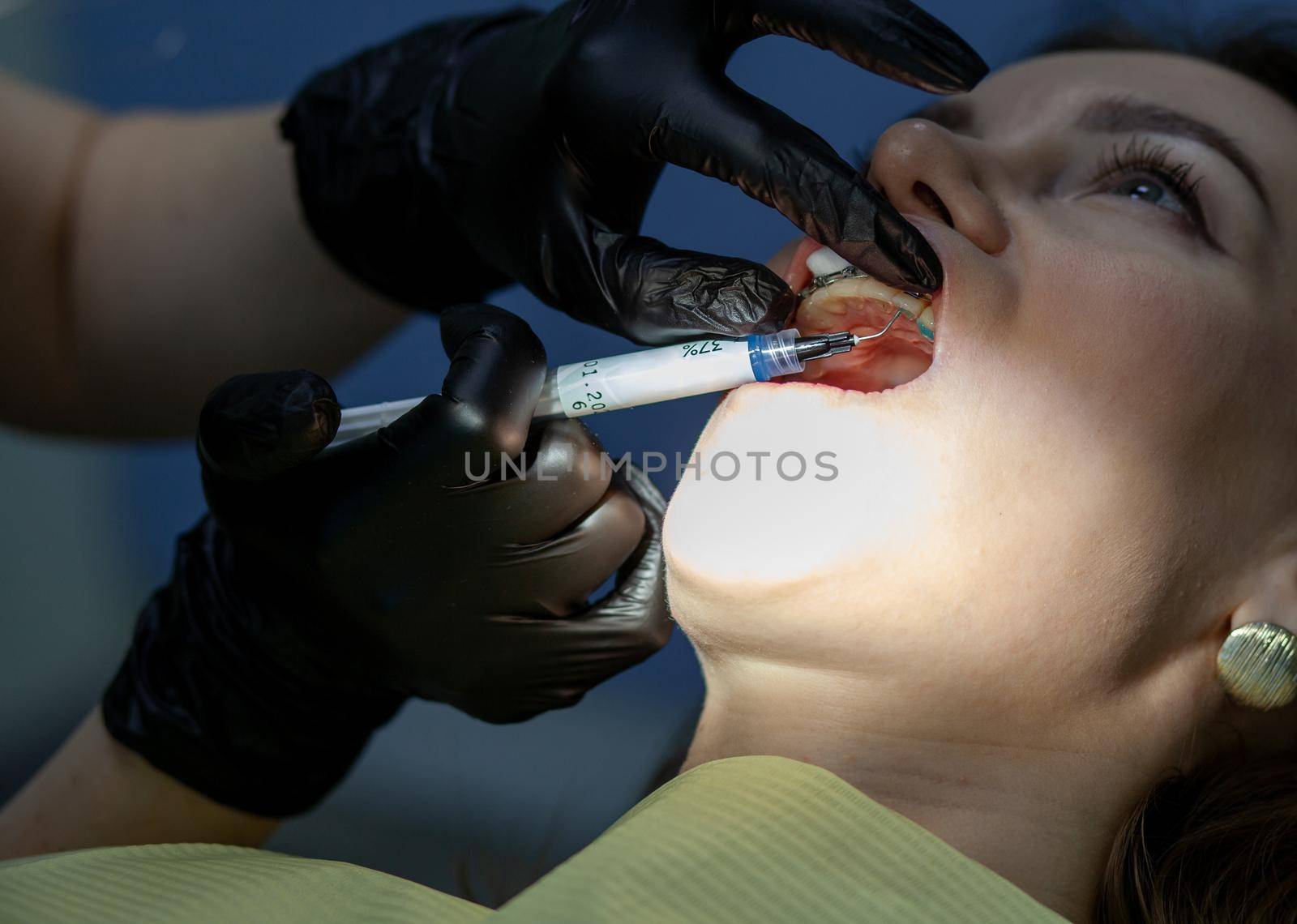 A woman at a dentist's appointment to replace arches with braces by AnatoliiFoto